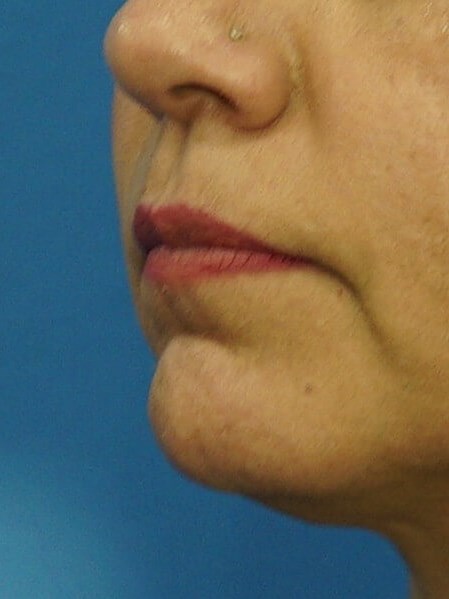 Lip Filler Before & After Before