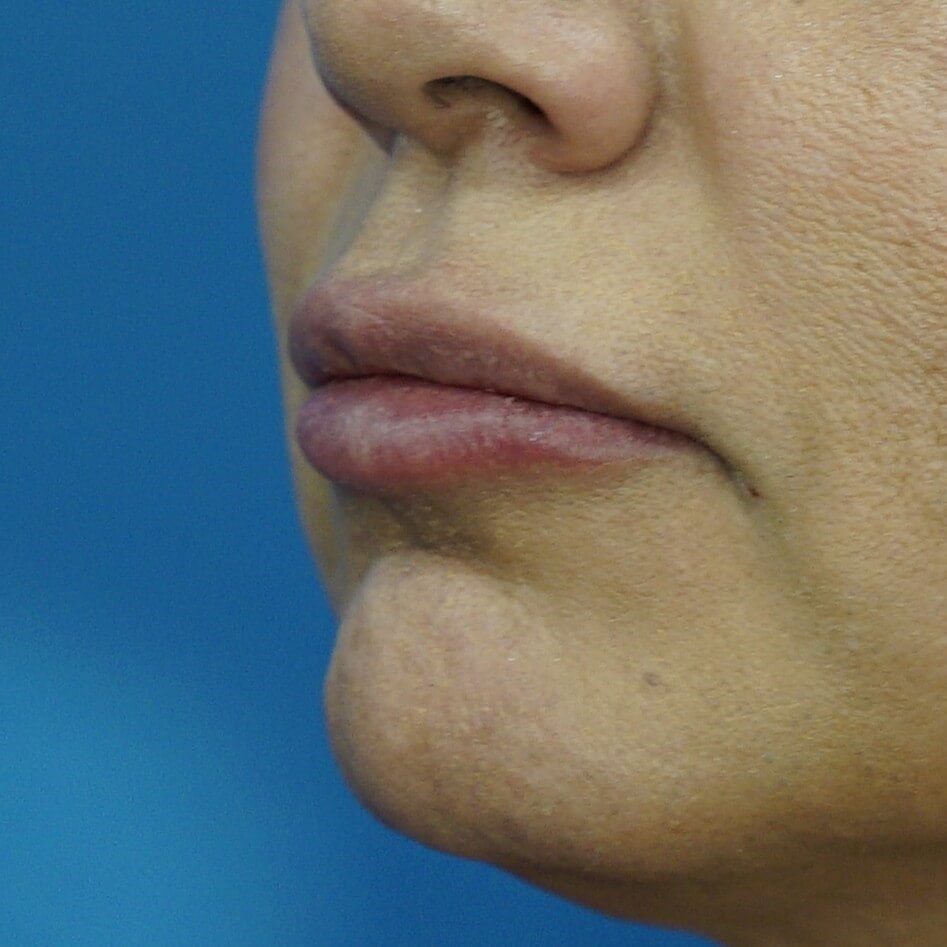 Lip Filler Before & After After