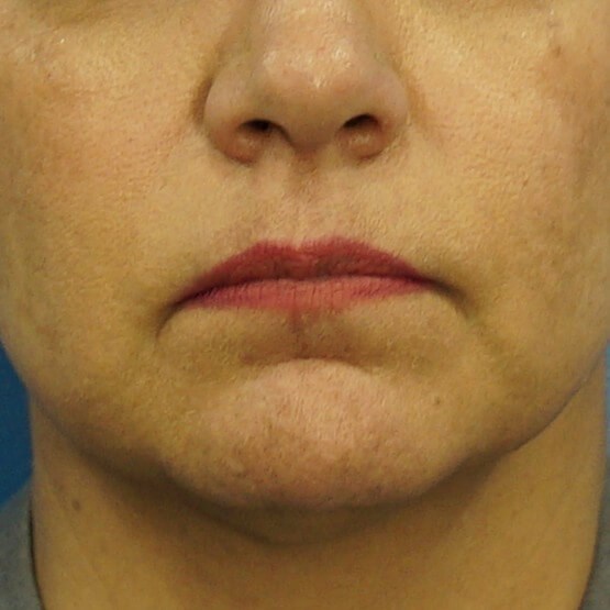 Lip Filler Before & After Before