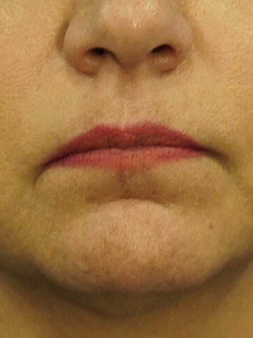 Lip Filler Before & After Before