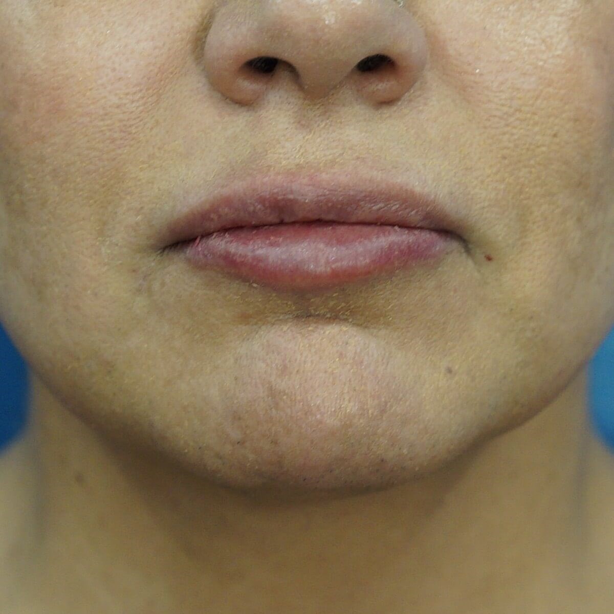 Lip Filler Before & After After