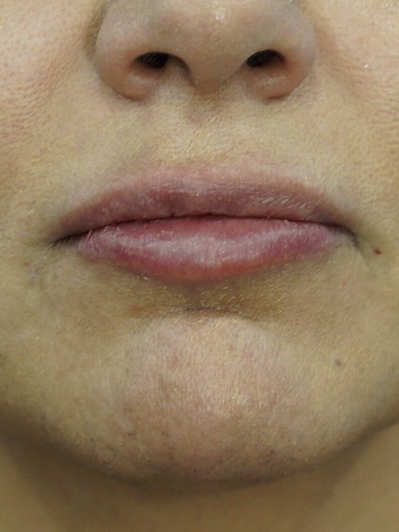 Lip Filler Before & After After