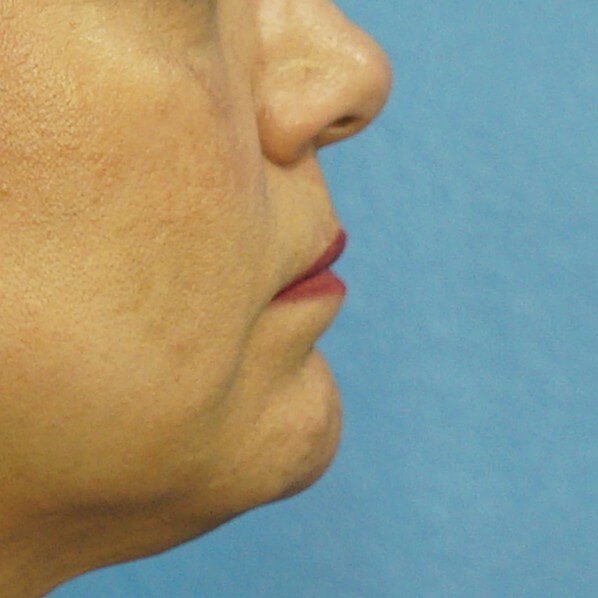 Lip Filler Before & After Before