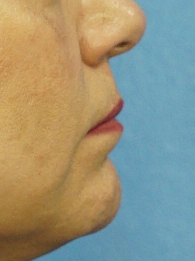Lip Filler Before & After Before