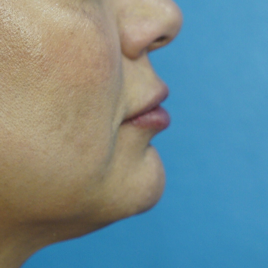 Lip Filler Before & After After