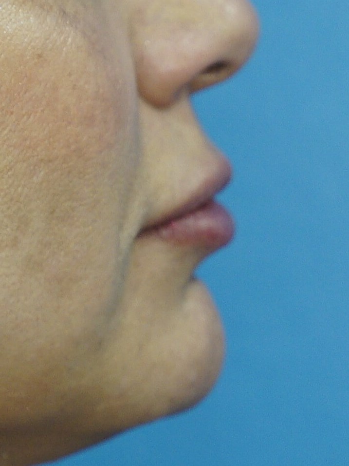 Lip Filler Before & After After