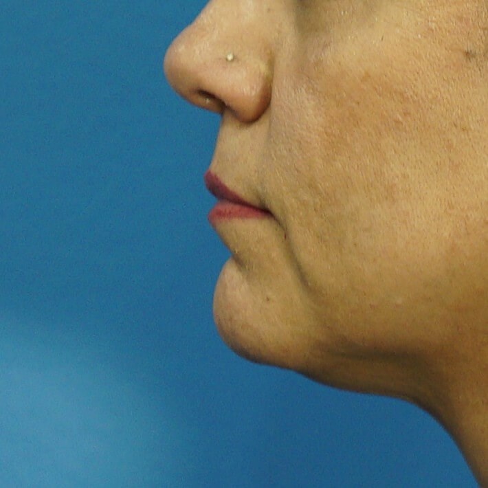 Lip Filler Before & After Before