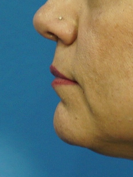 Lip Filler Before & After Before