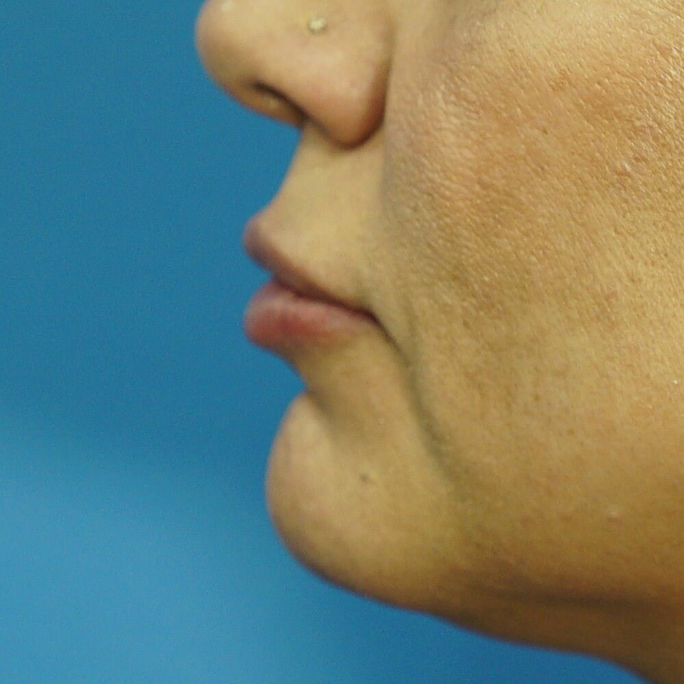 Lip Filler Before & After After