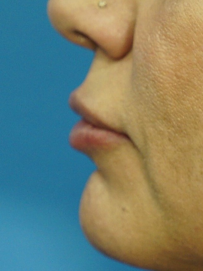 Lip Filler Before & After After