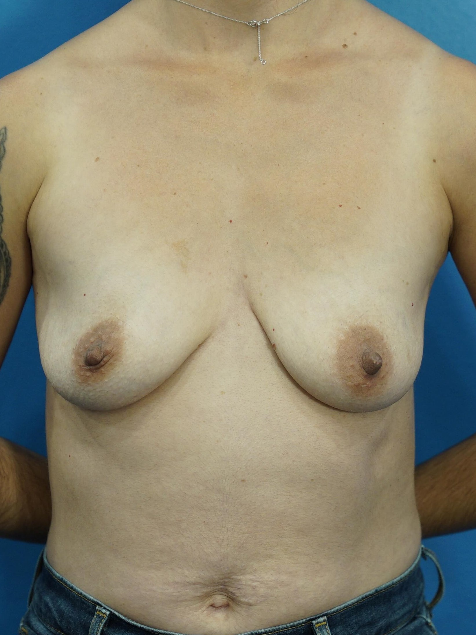 Westlake Woman Has Breast Aug Before