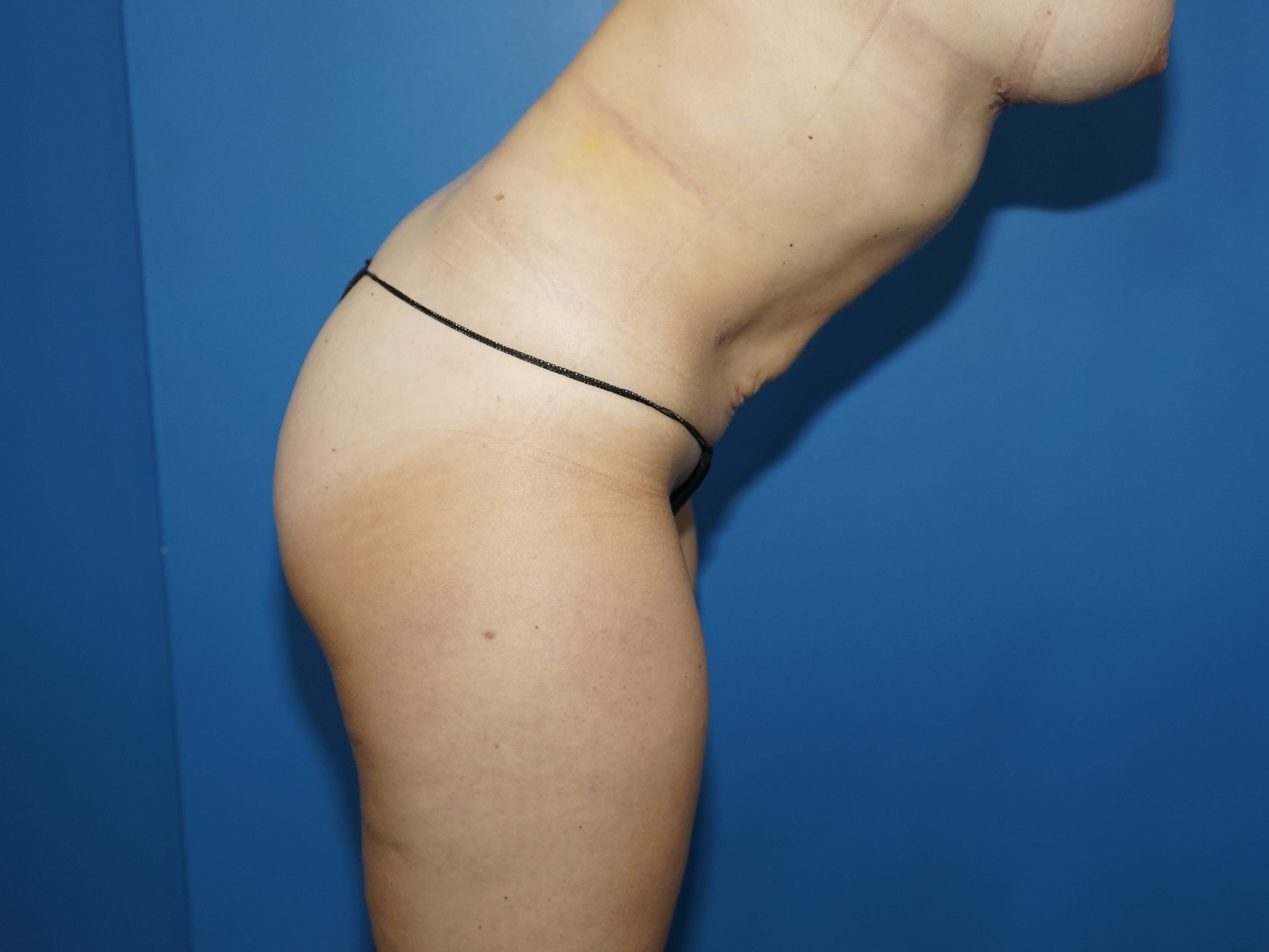 Westlake Woman has Liposuction After