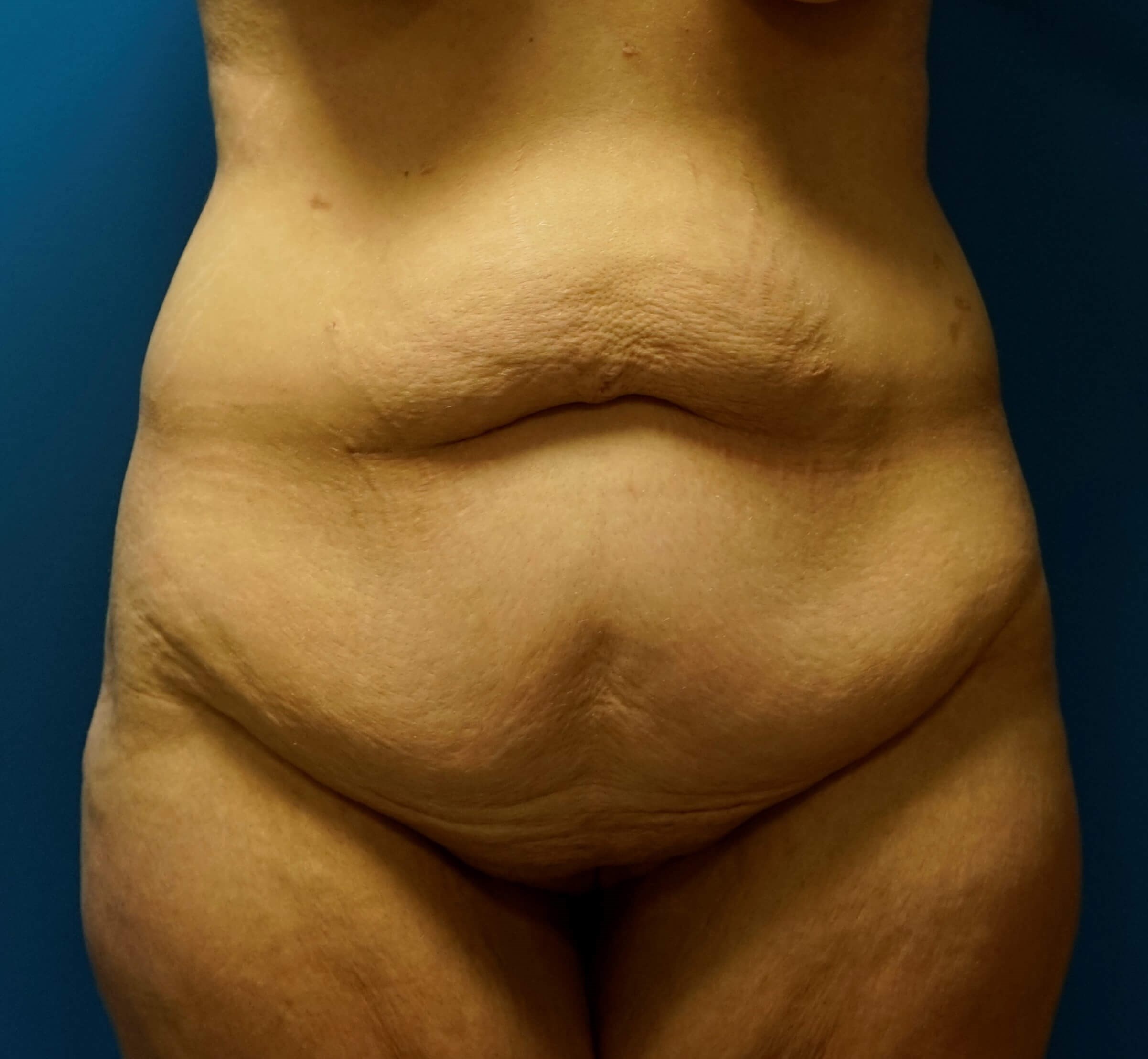 Westlake Woman Has Tummy Tuck Before