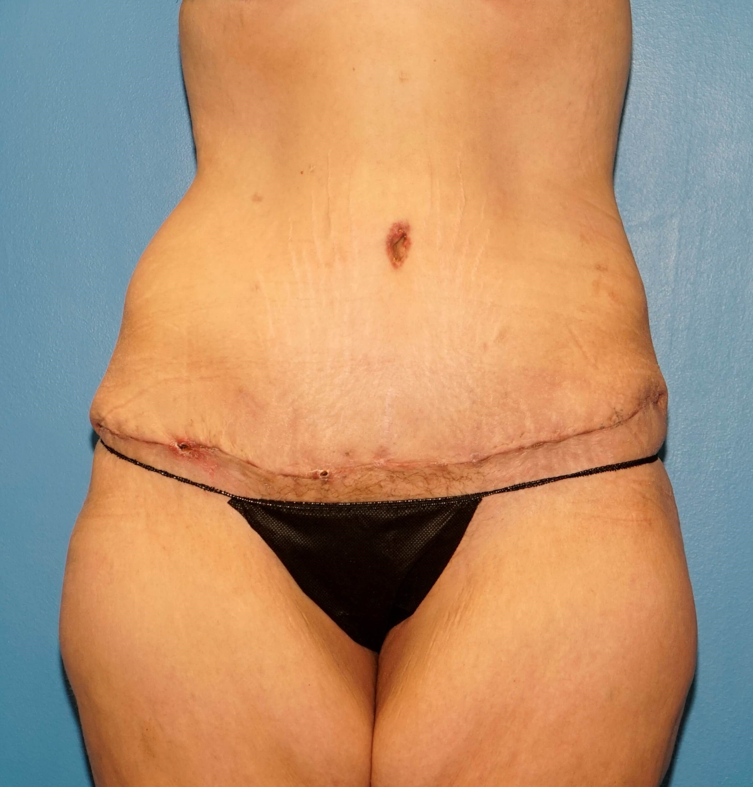 Westlake Woman Has Tummy Tuck After
