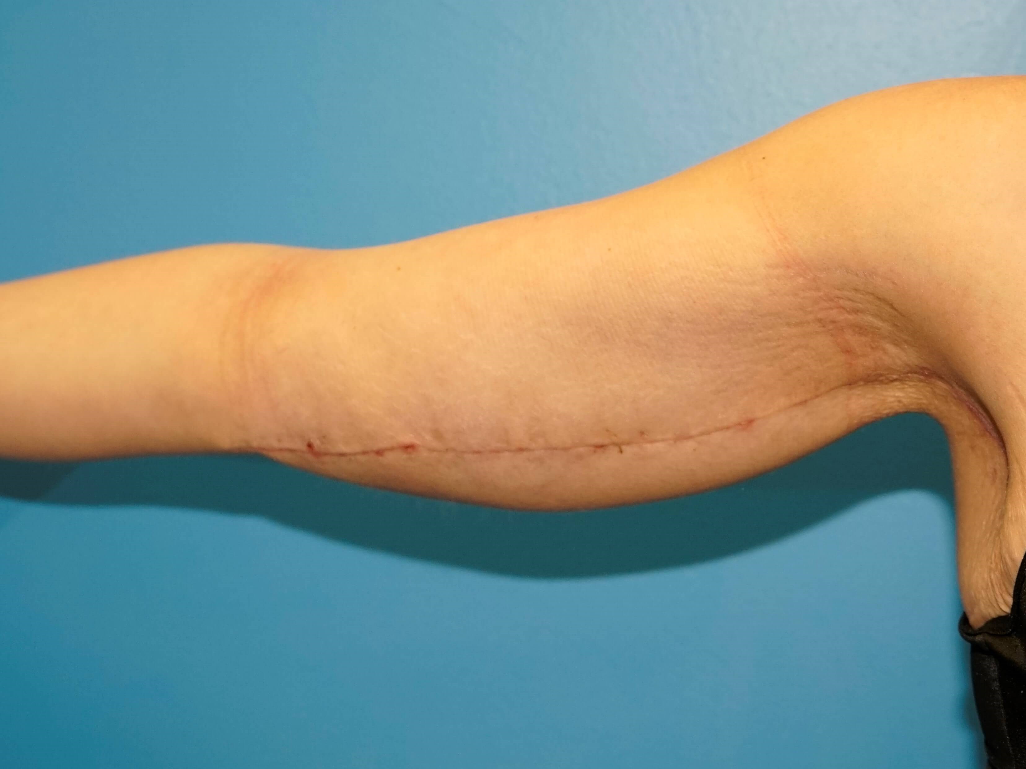 Woman has arm lift After