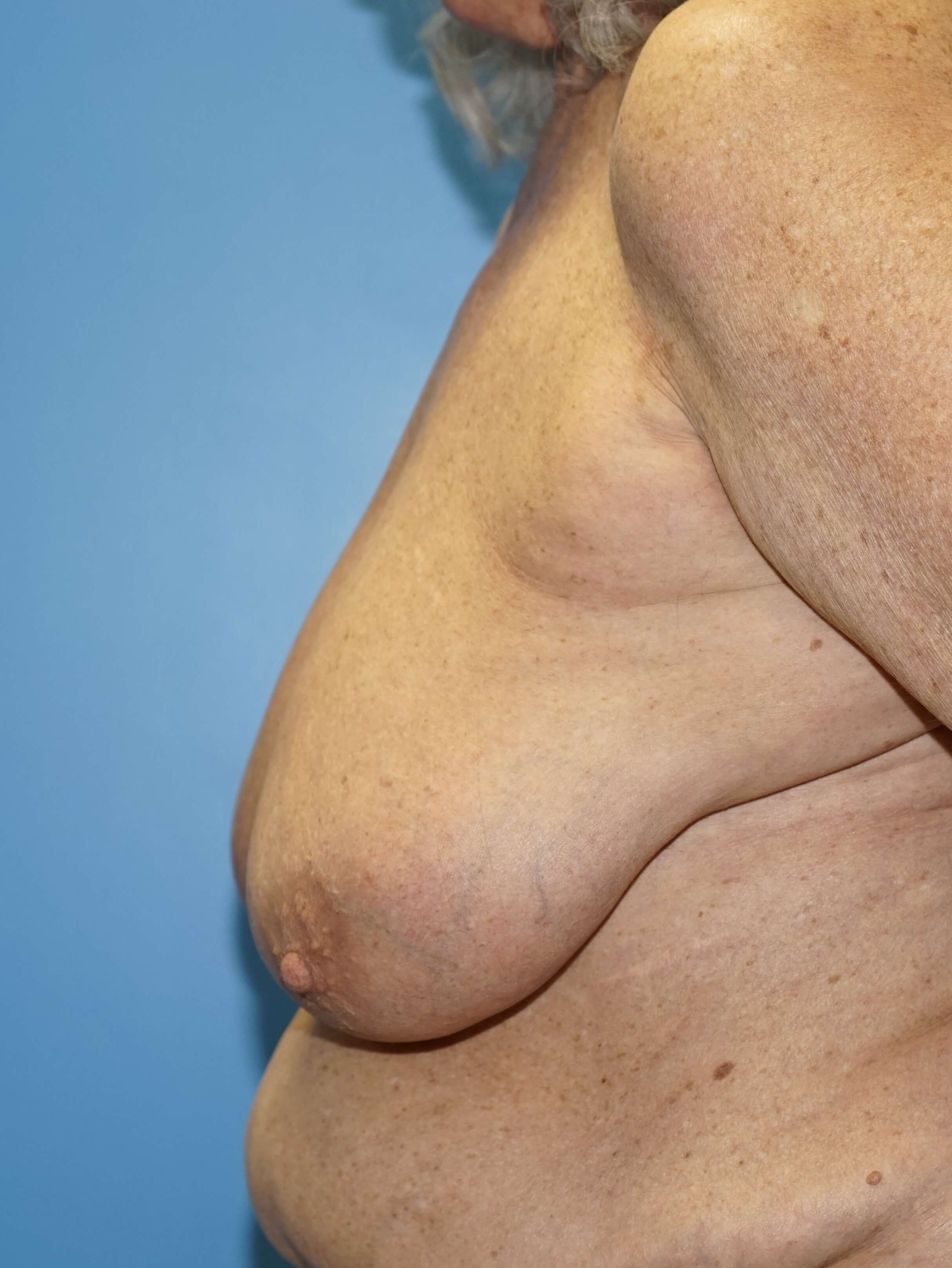 Woman has Breast Lift Before