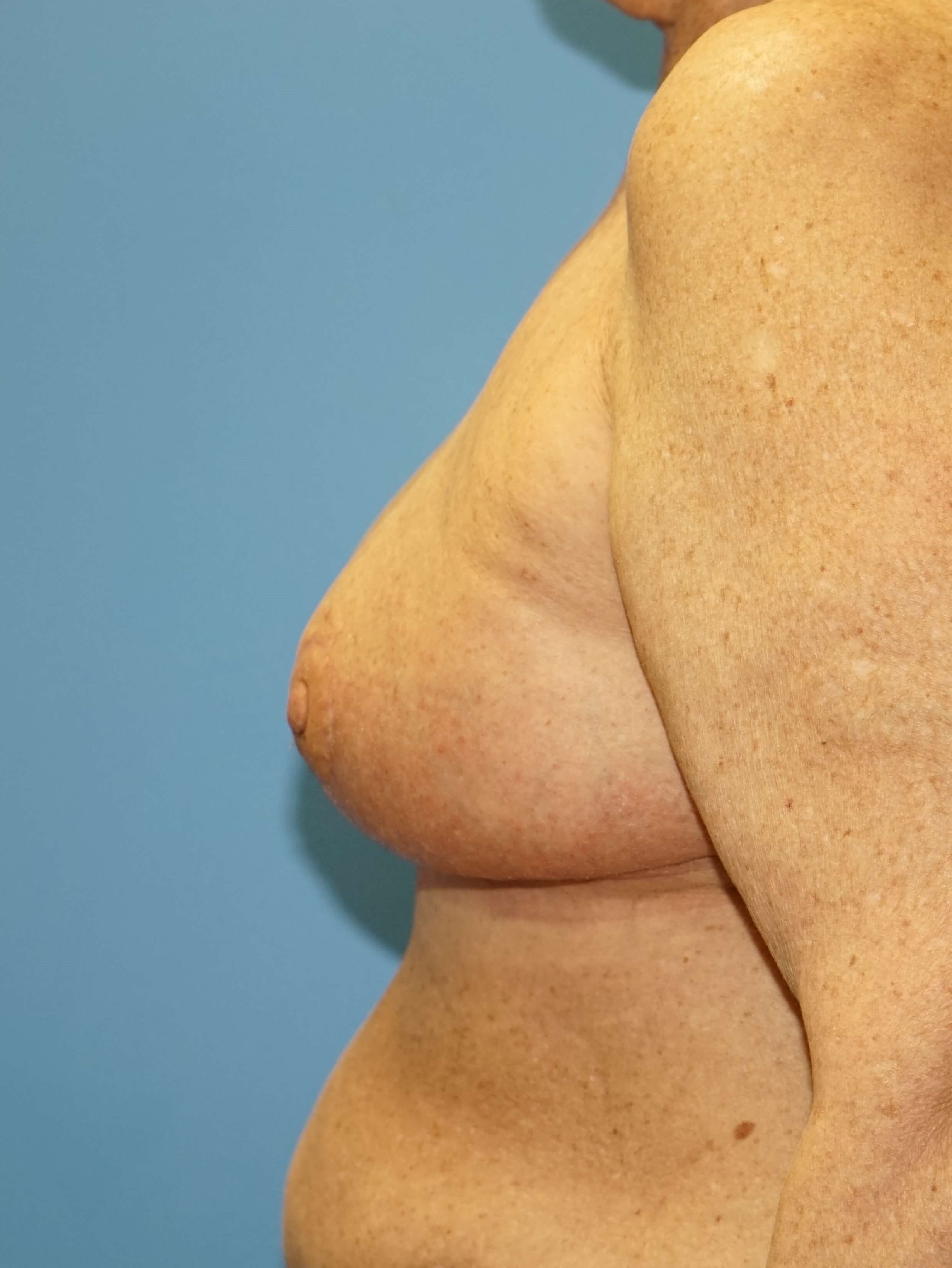Woman has Breast Lift After
