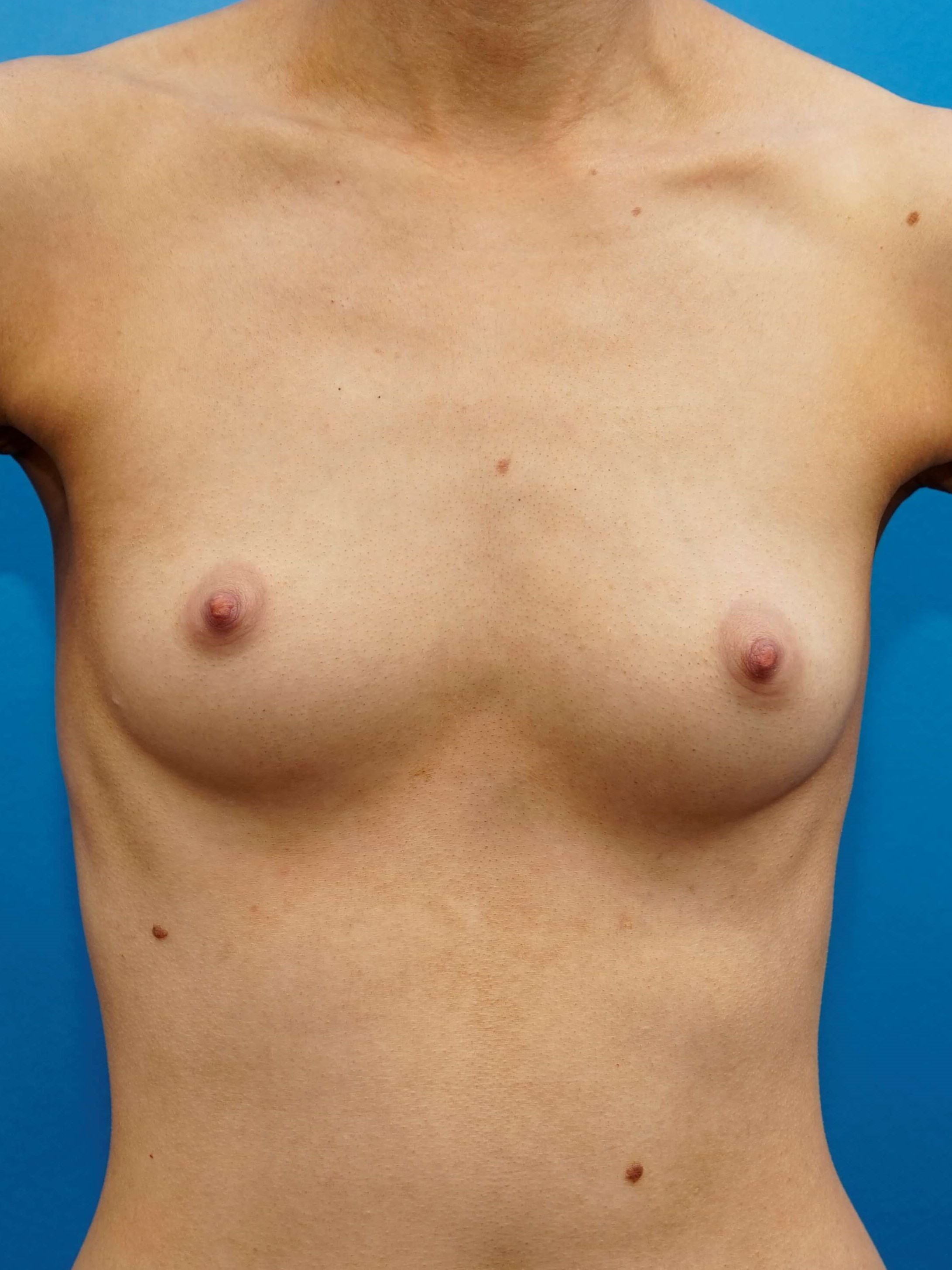 Westlake Woman Has Breast Aug Before