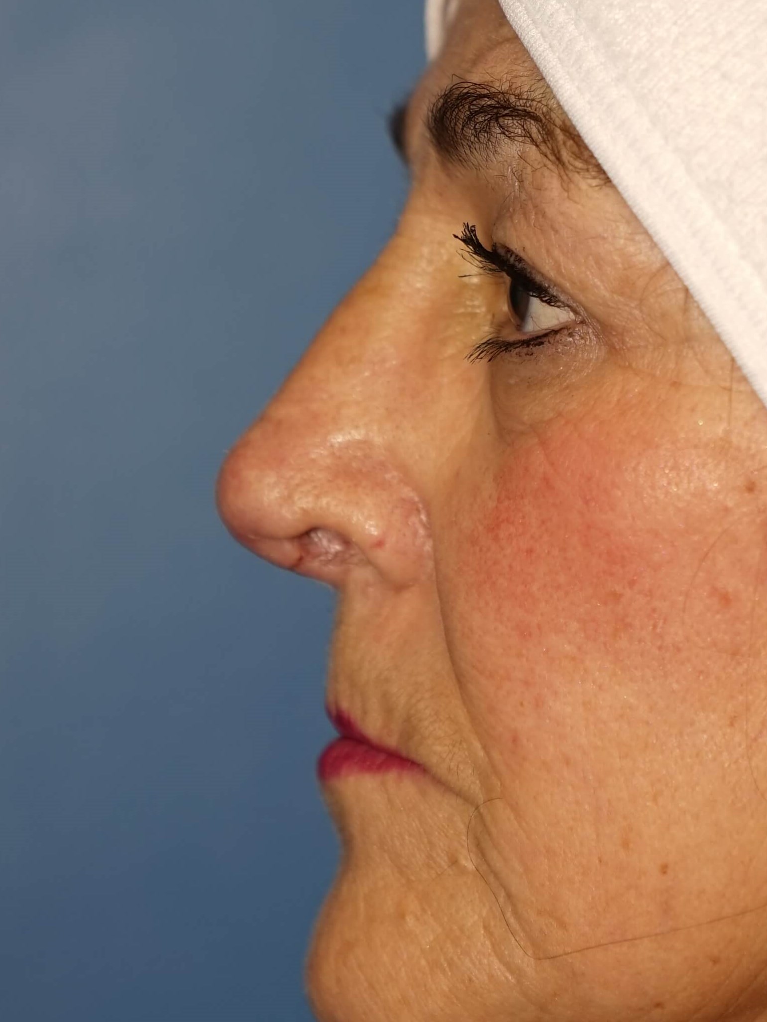 Westlake Woman has Rhinoplasty After