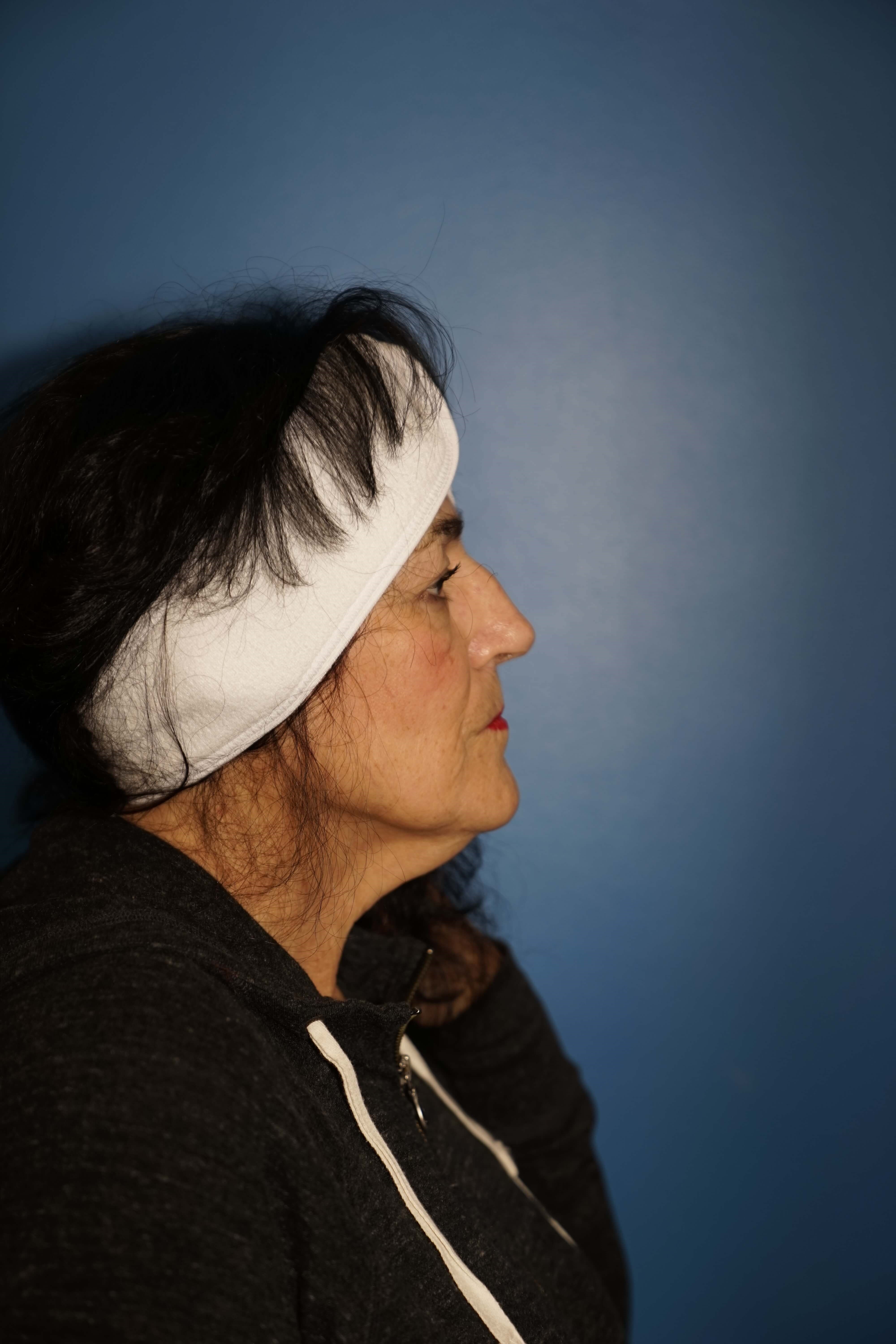 Westlake Woman has Rhinoplasty Before