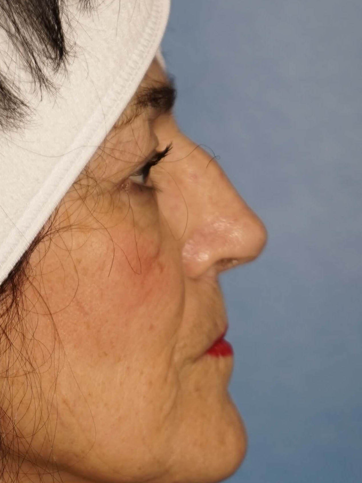 Westlake Woman has Rhinoplasty Before