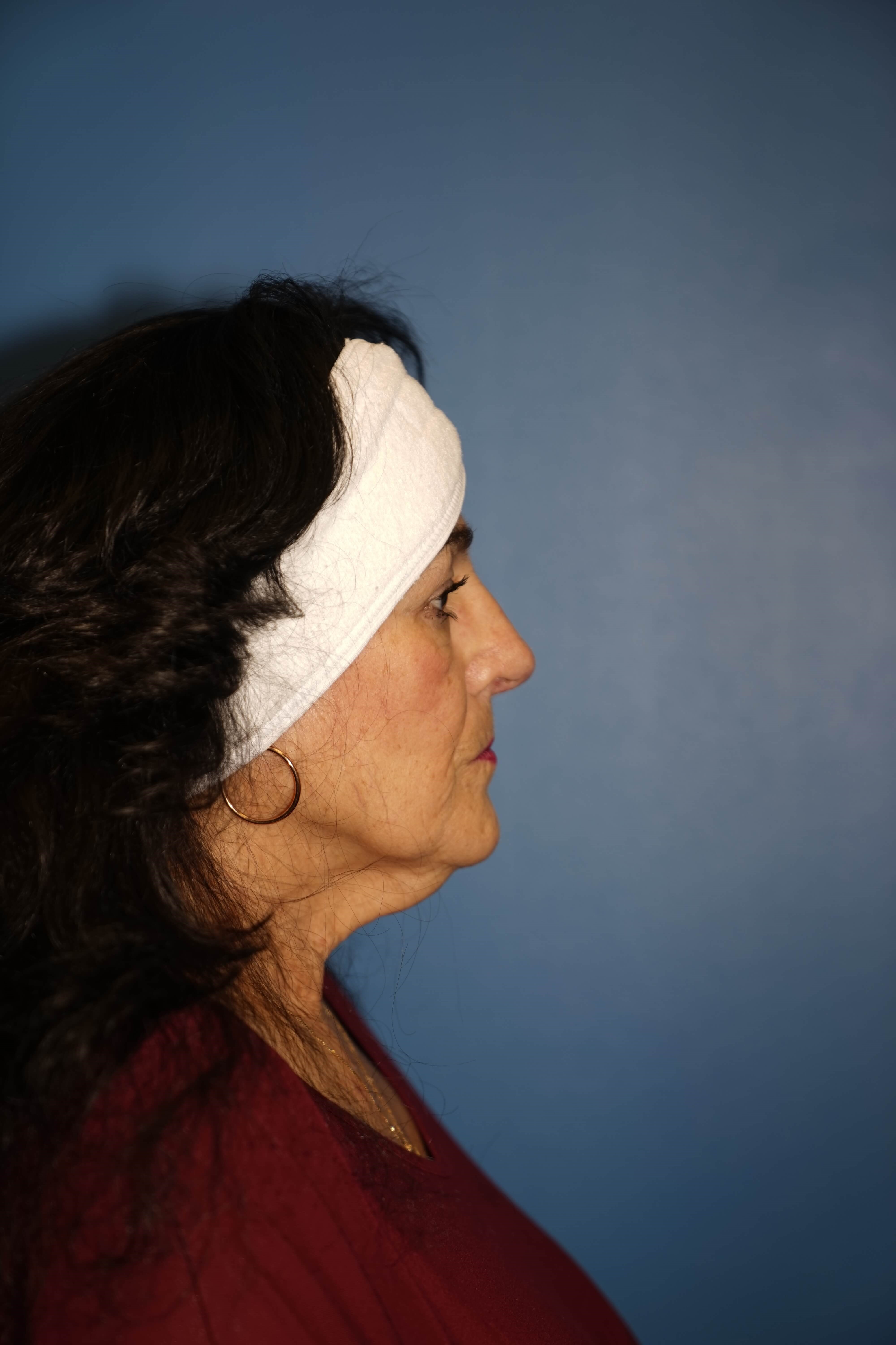 Westlake Woman has Rhinoplasty After