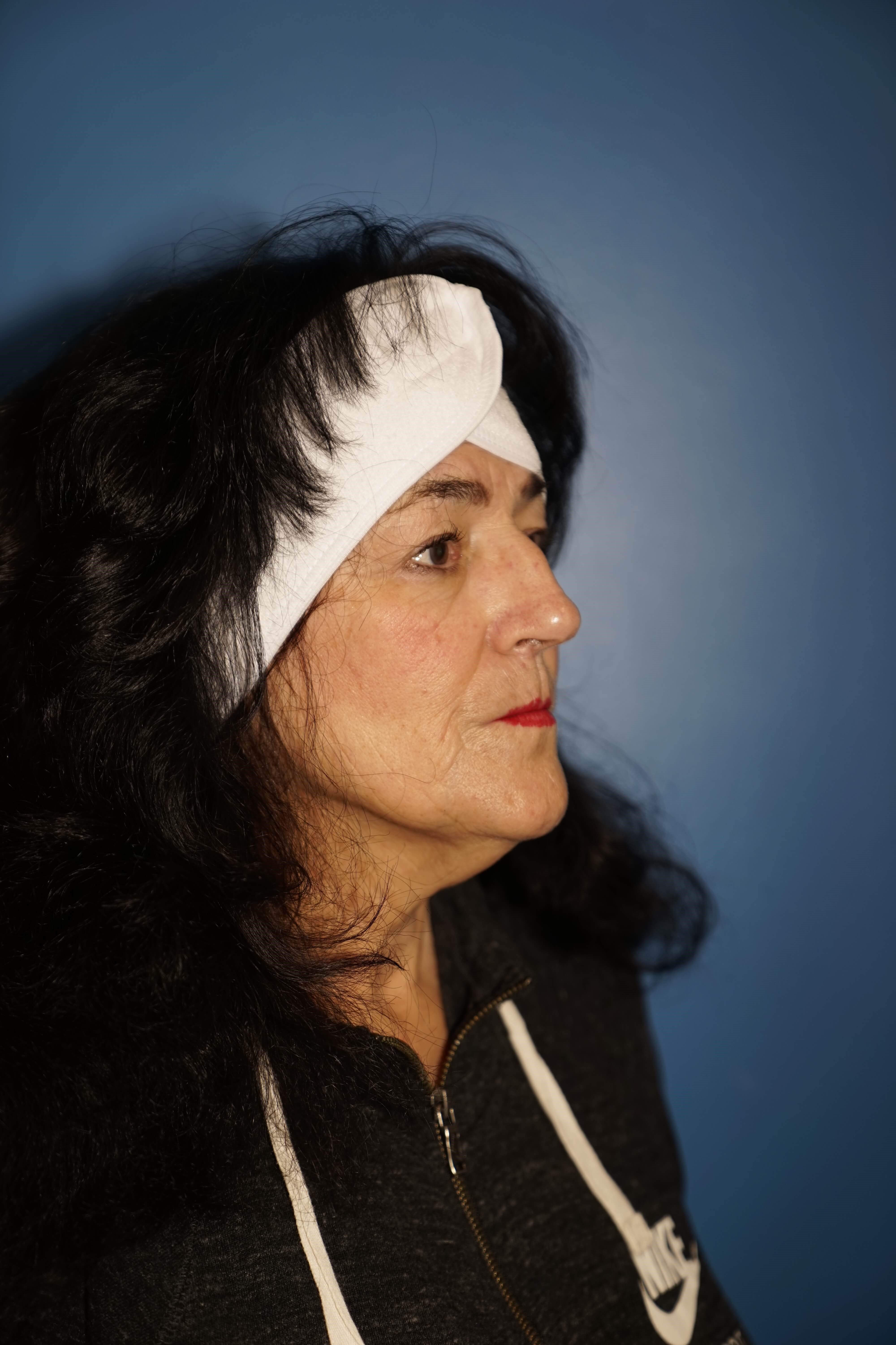 Westlake Woman has Rhinoplasty Before