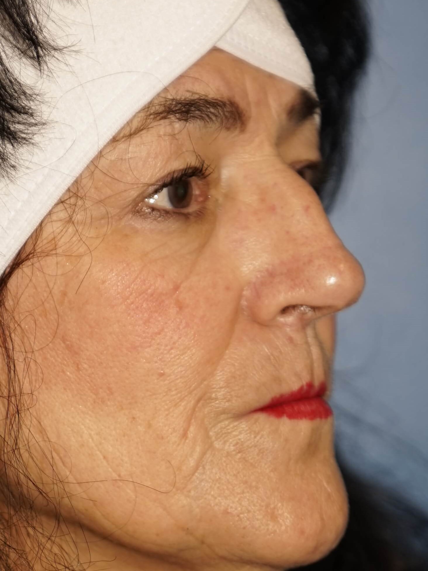 Westlake Woman has Rhinoplasty Before