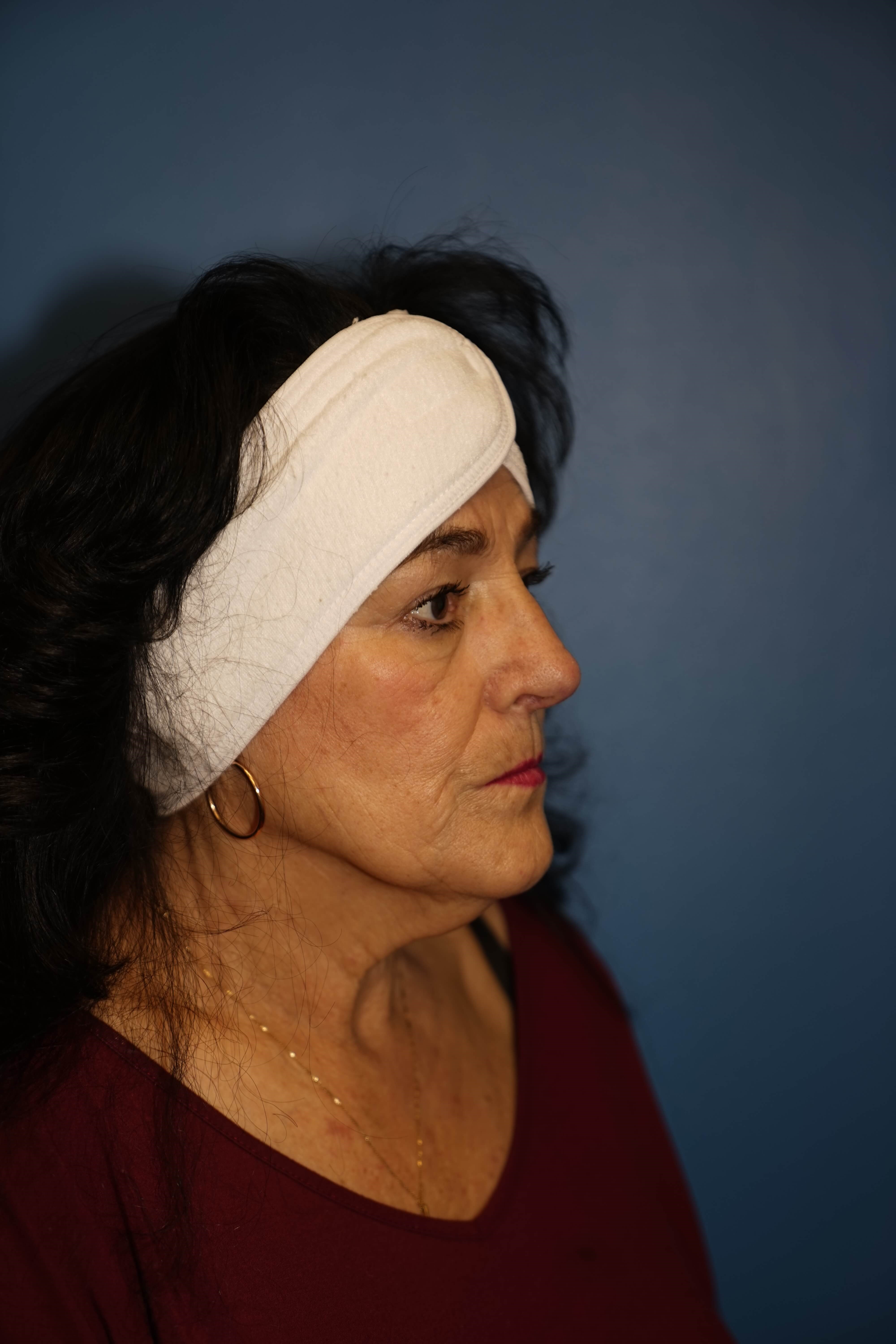 Westlake Woman has Rhinoplasty After