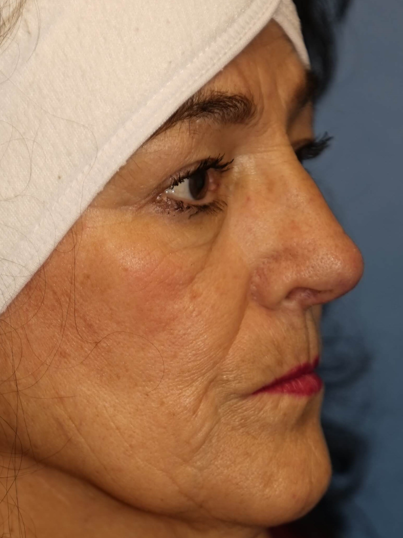 Westlake Woman has Rhinoplasty After