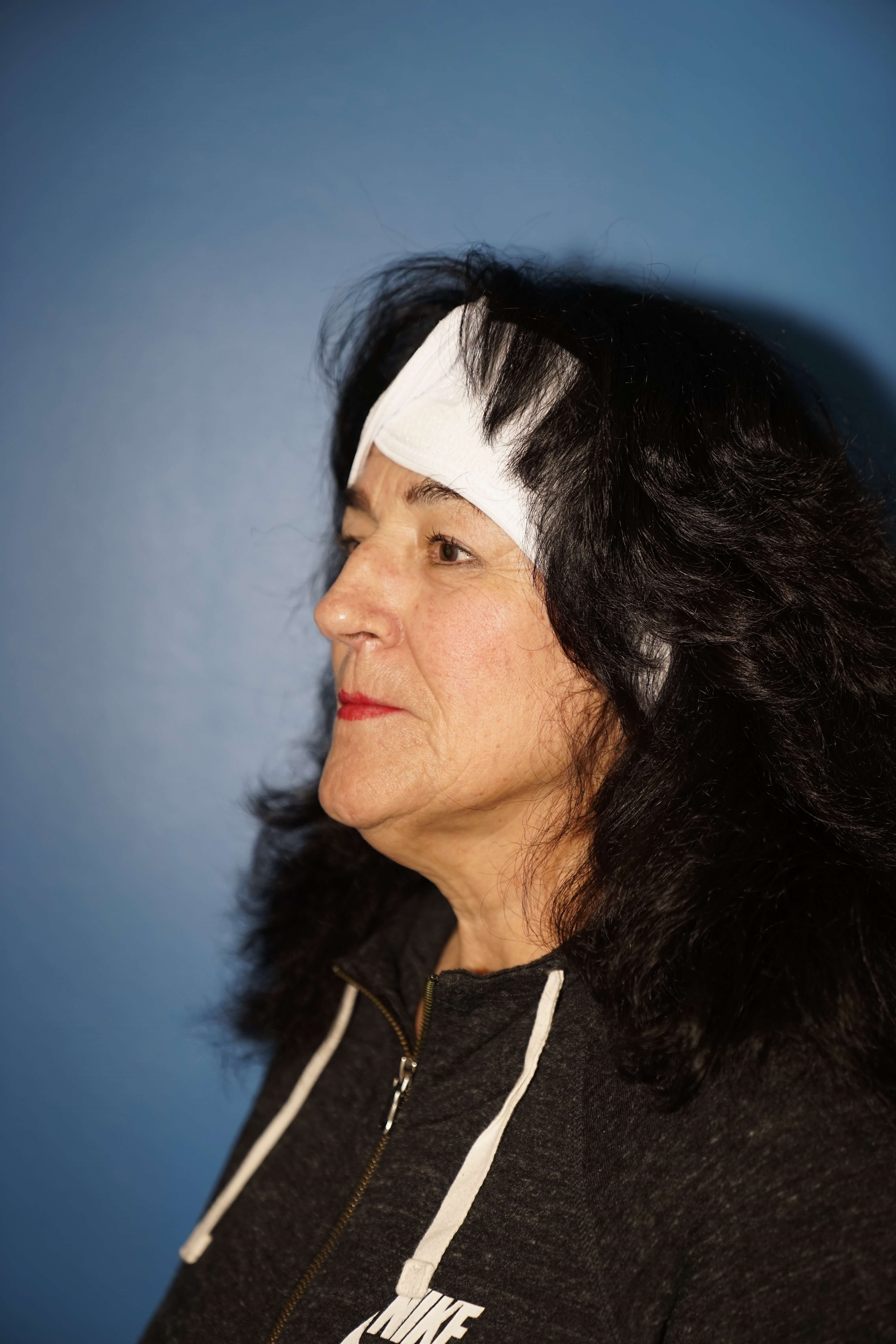 Westlake Woman has Rhinoplasty Before