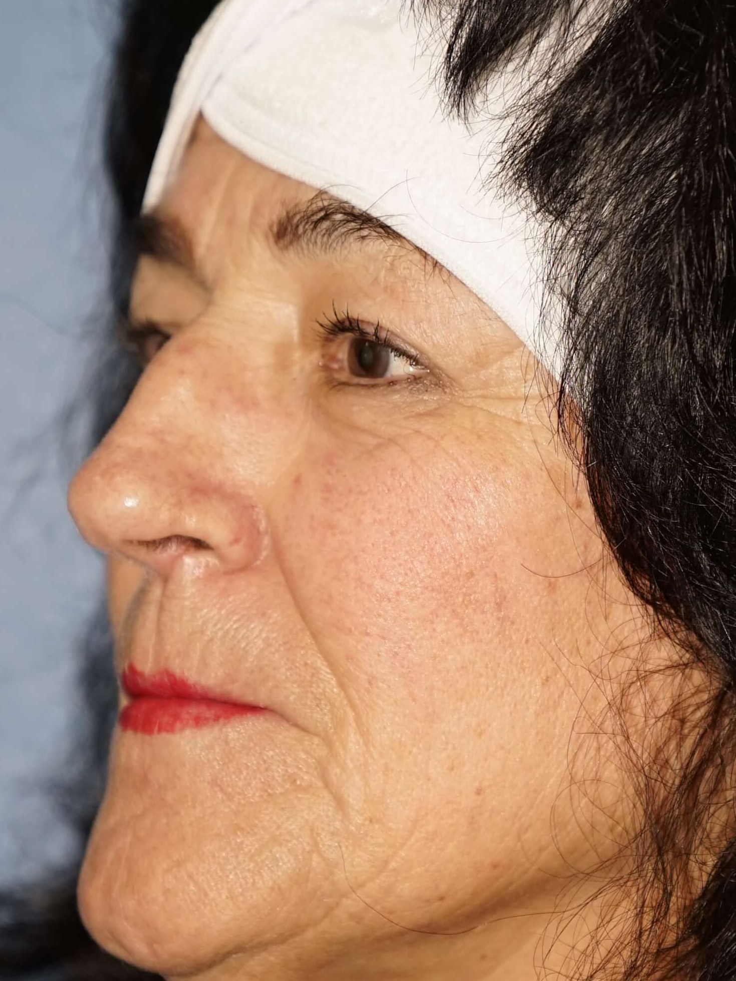 Westlake Woman has Rhinoplasty Before
