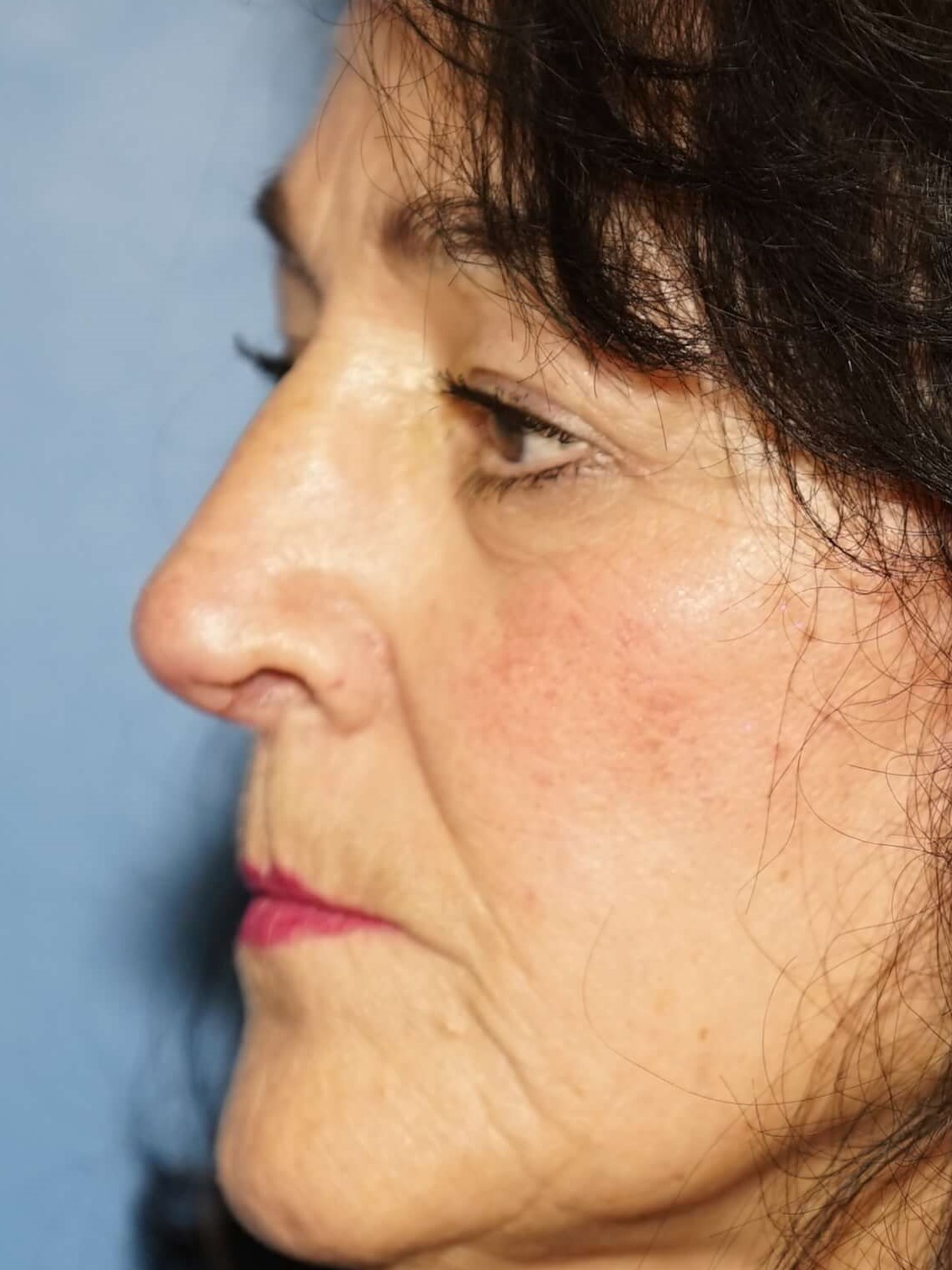 Westlake Woman has Rhinoplasty After