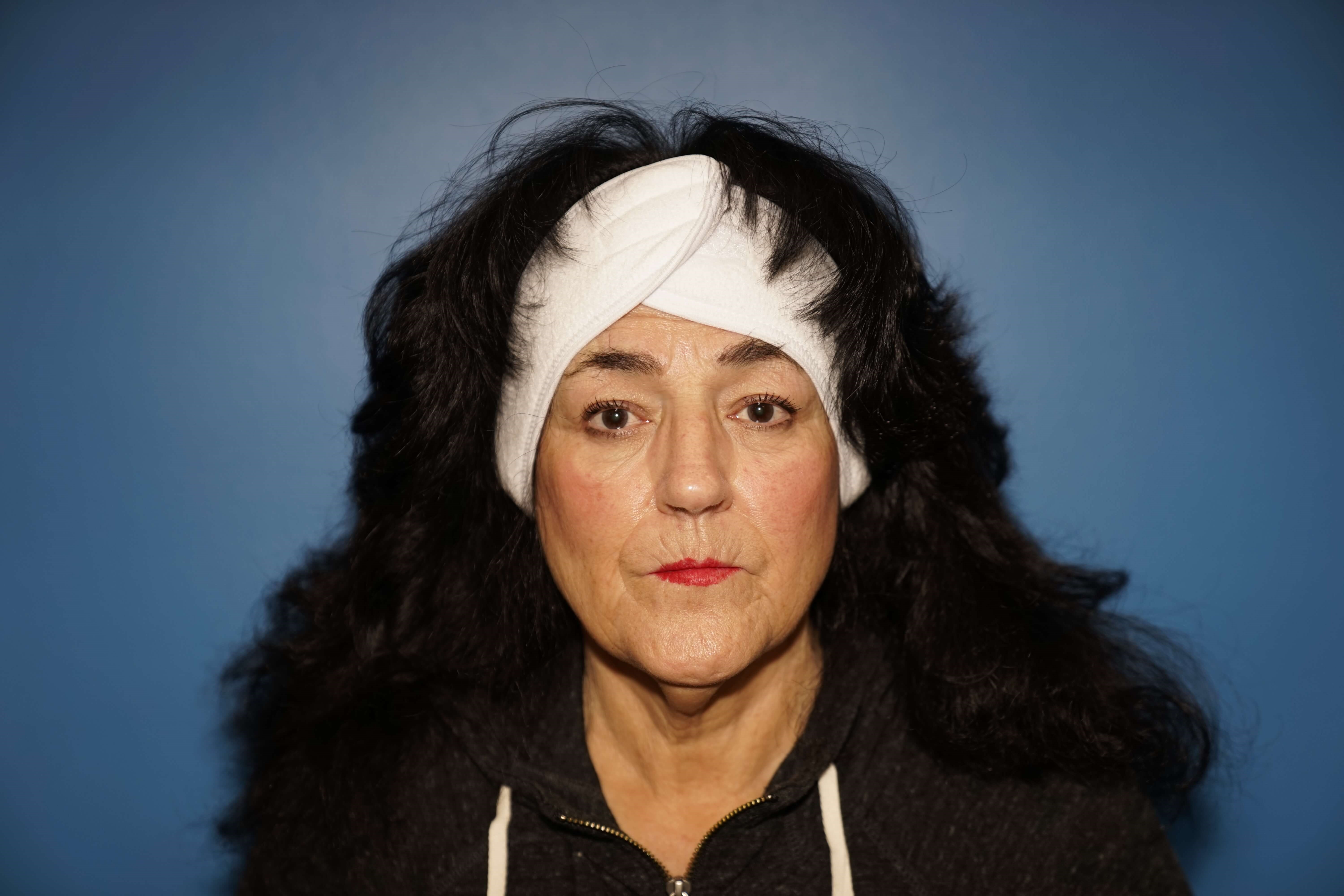 Westlake Woman has Rhinoplasty Before
