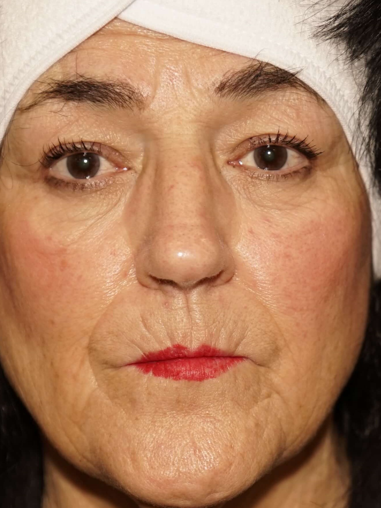 Westlake Woman has Rhinoplasty Before