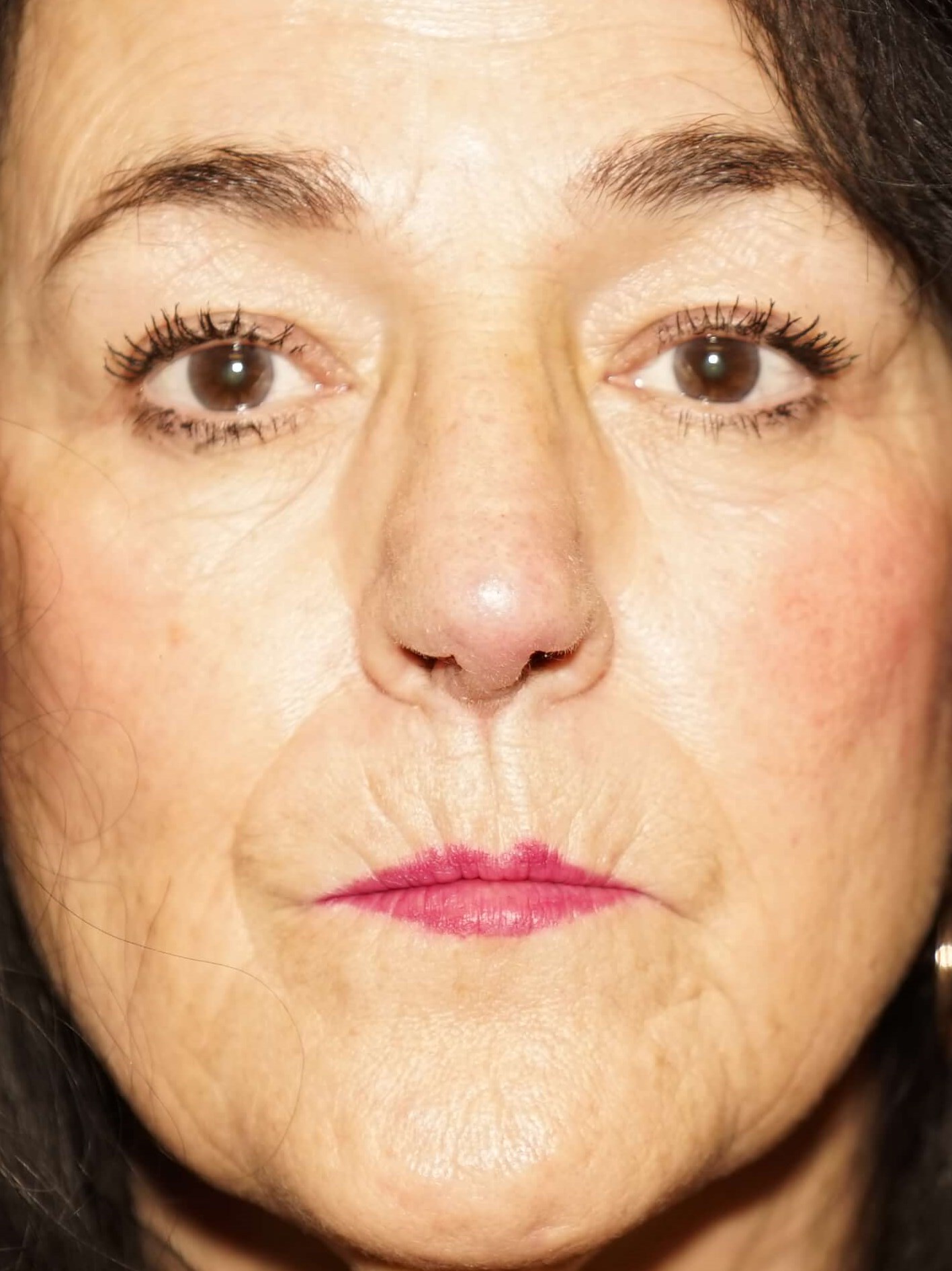 Westlake Woman has Rhinoplasty After