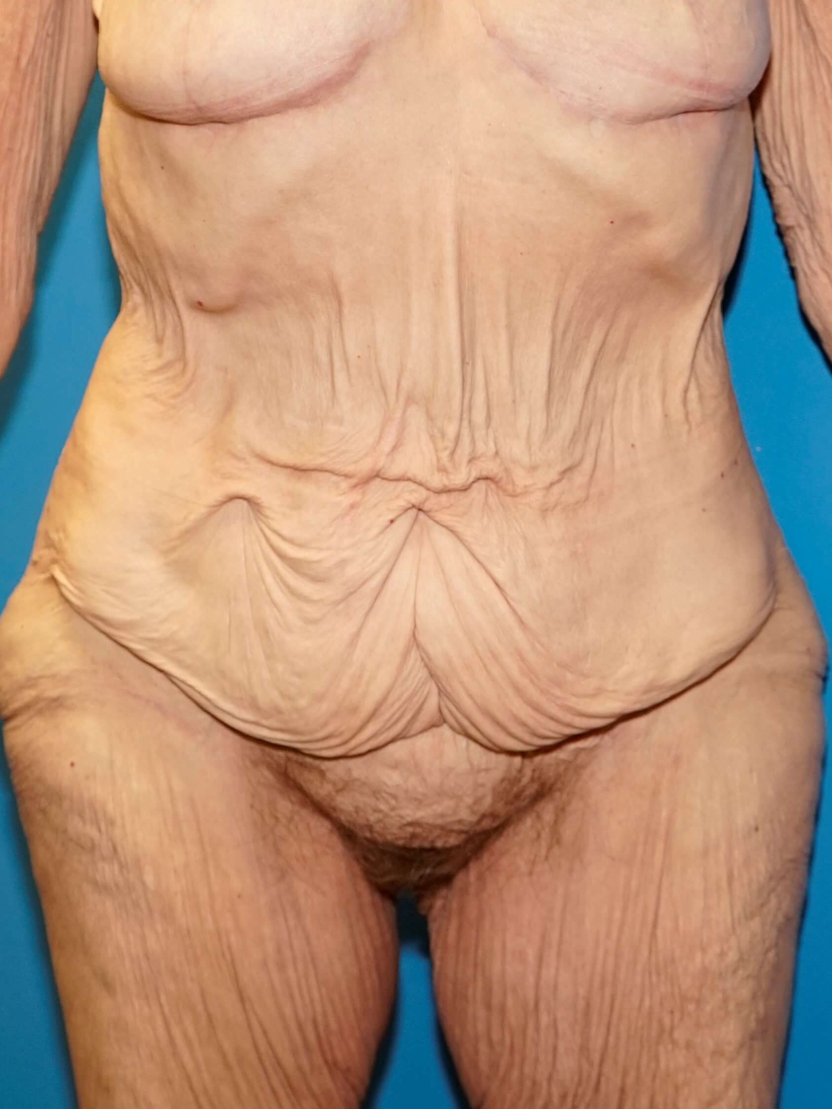 Westlake Woman Has Tummy Tuck Before
