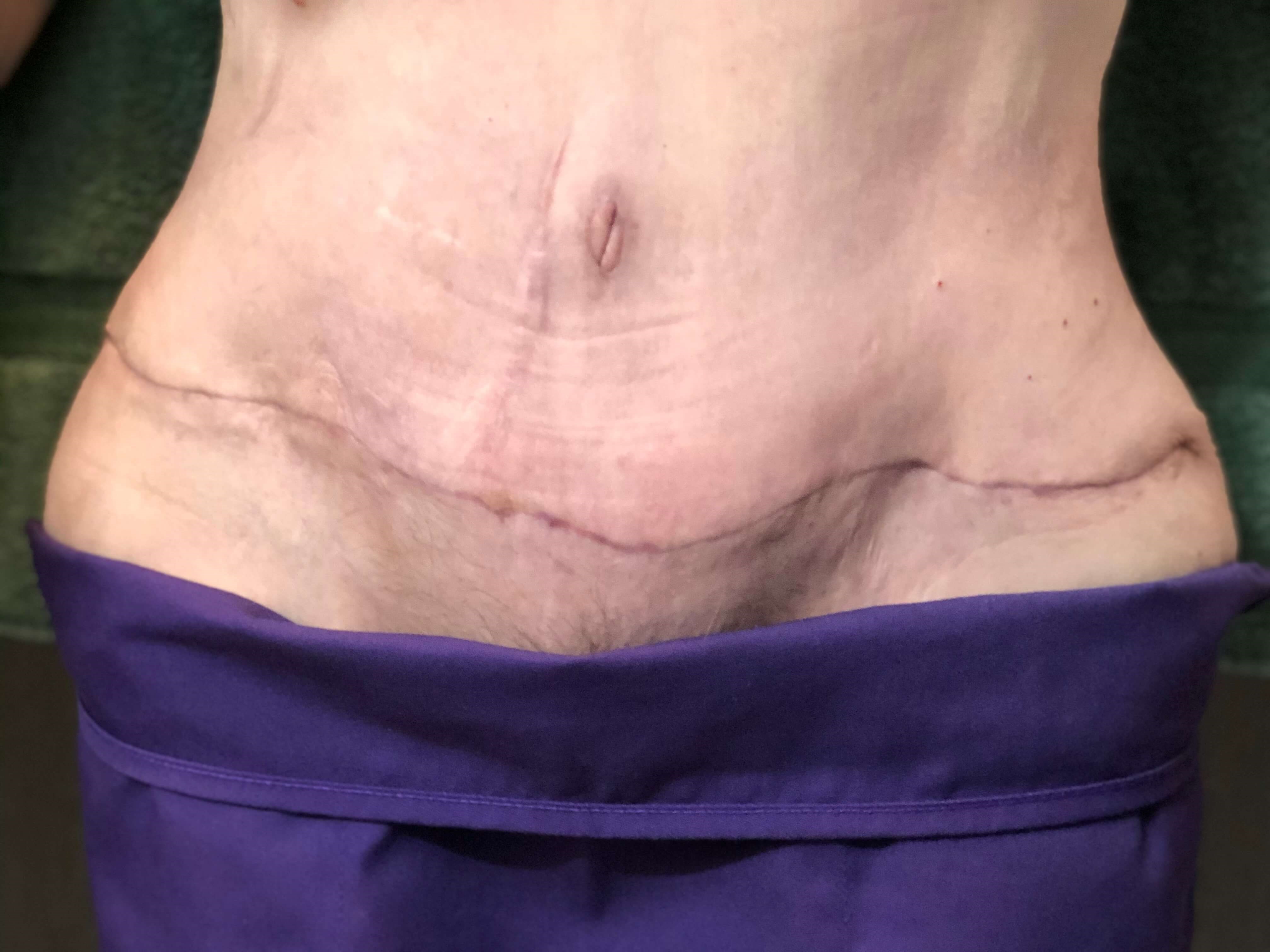 Westlake Woman Has Tummy Tuck After