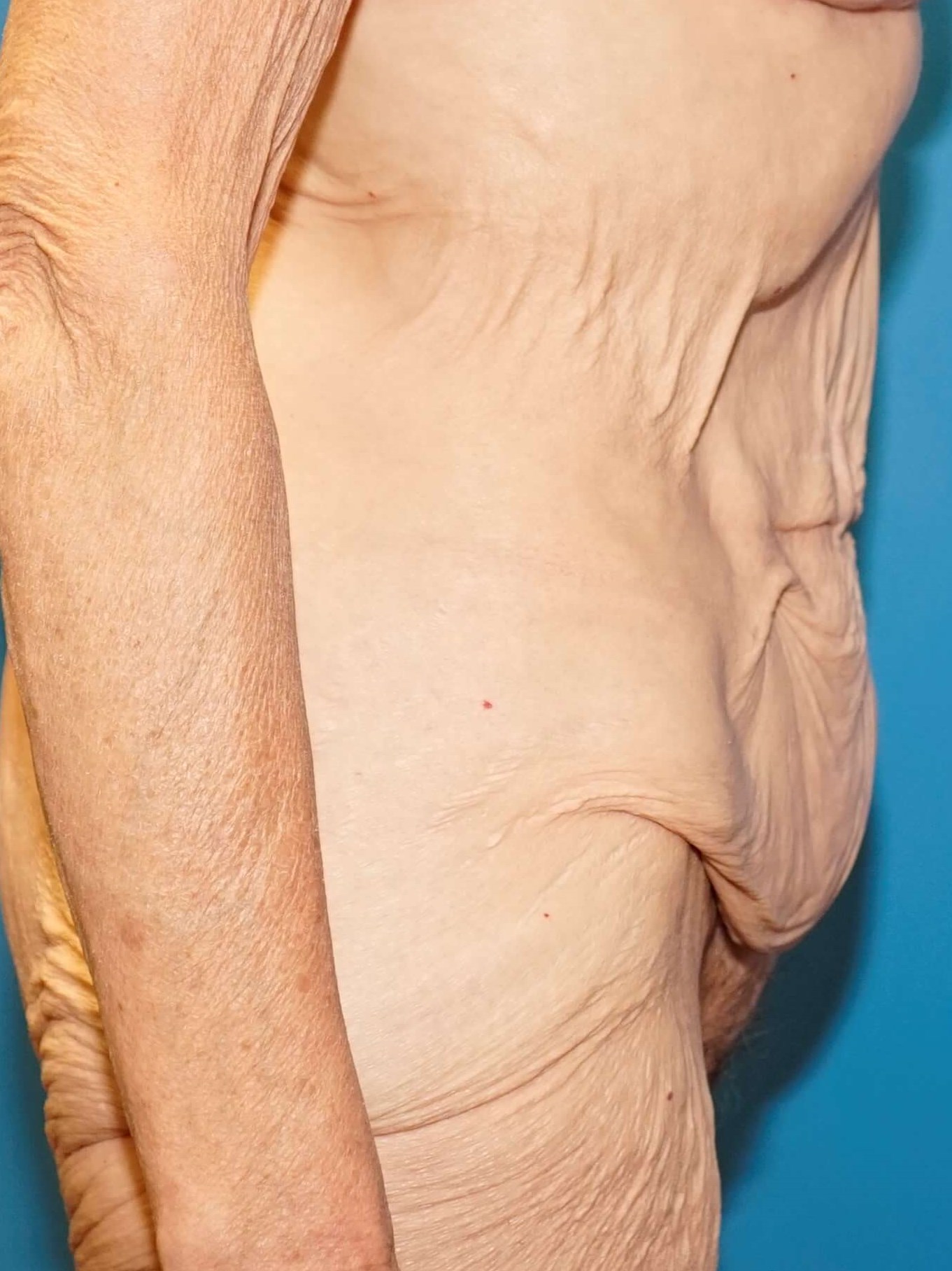 Westlake Woman Has Tummy Tuck Before