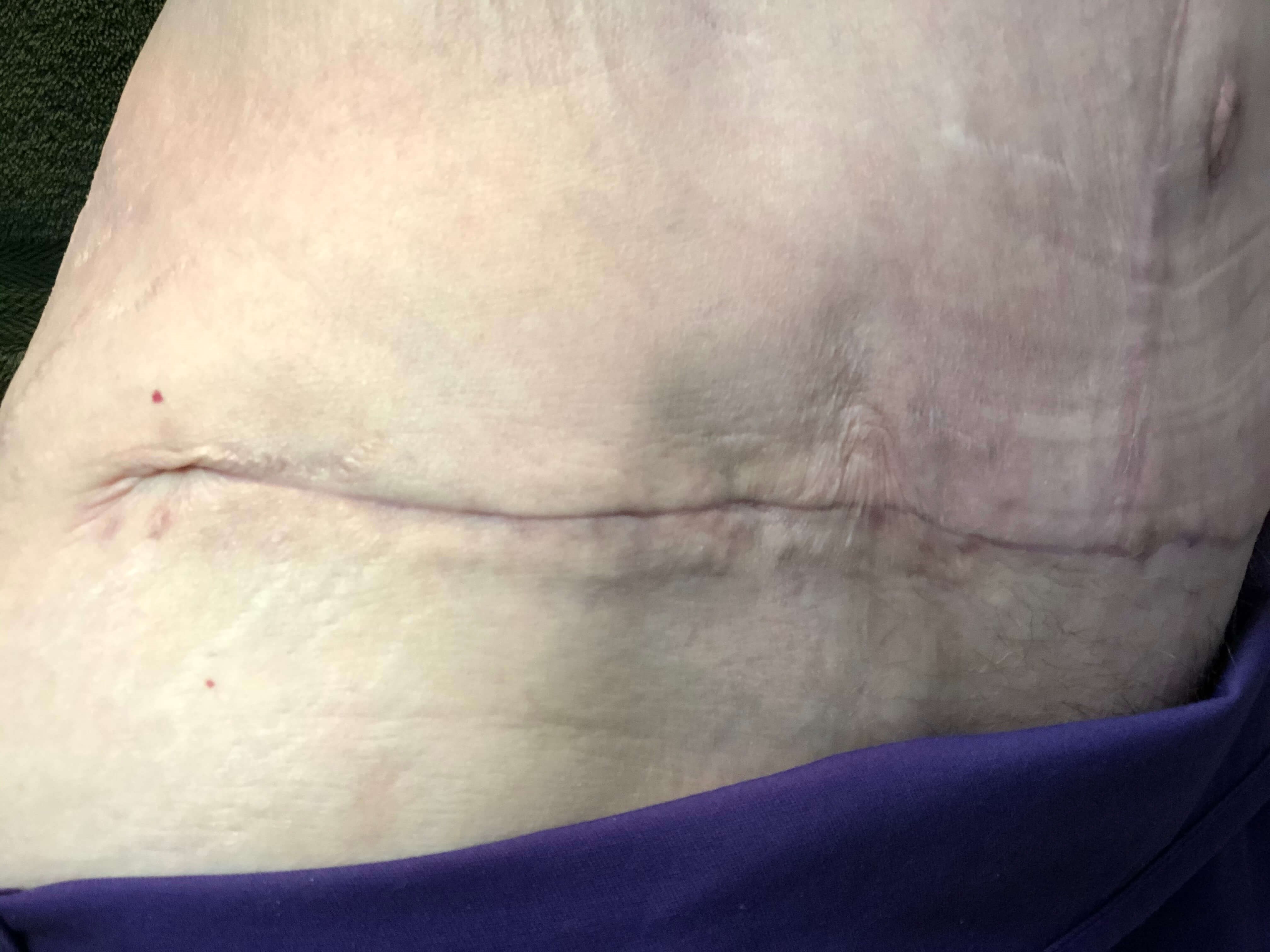 Westlake Woman Has Tummy Tuck After
