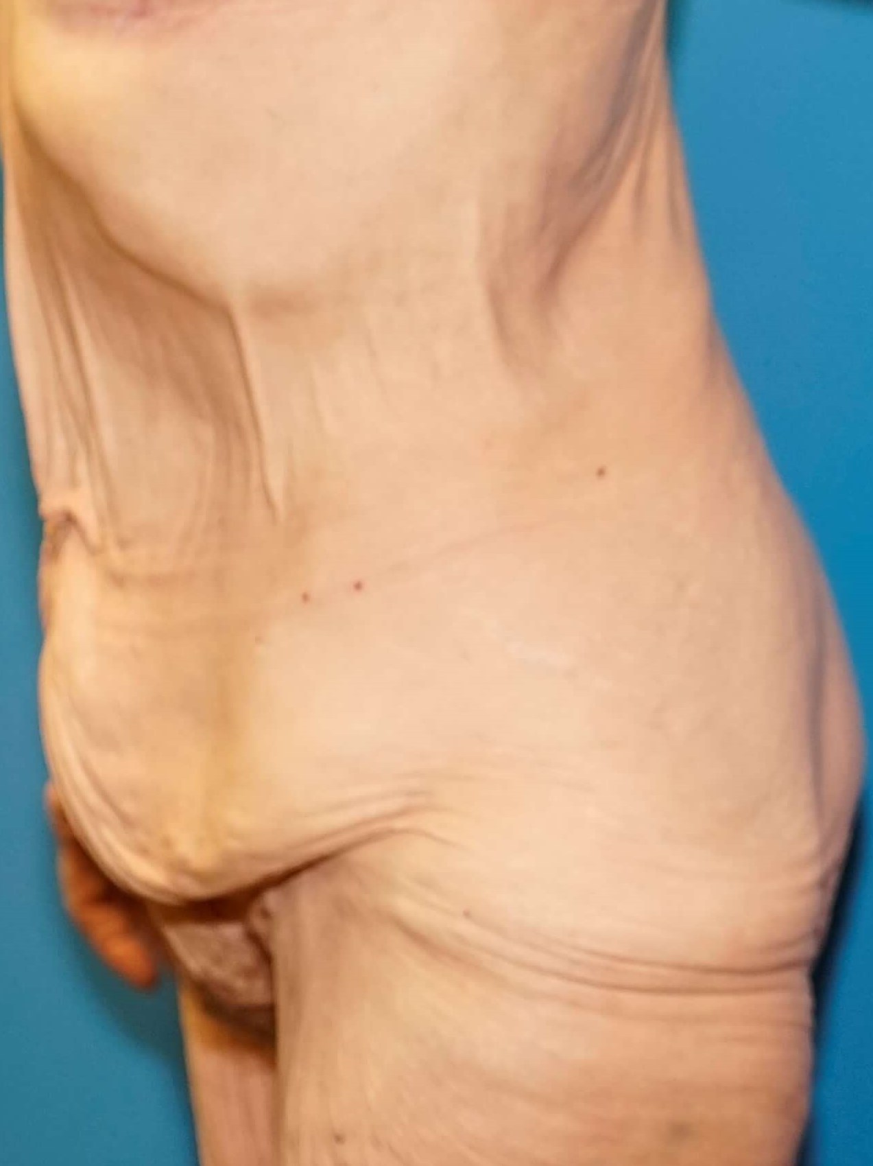 Westlake Woman Has Tummy Tuck Before