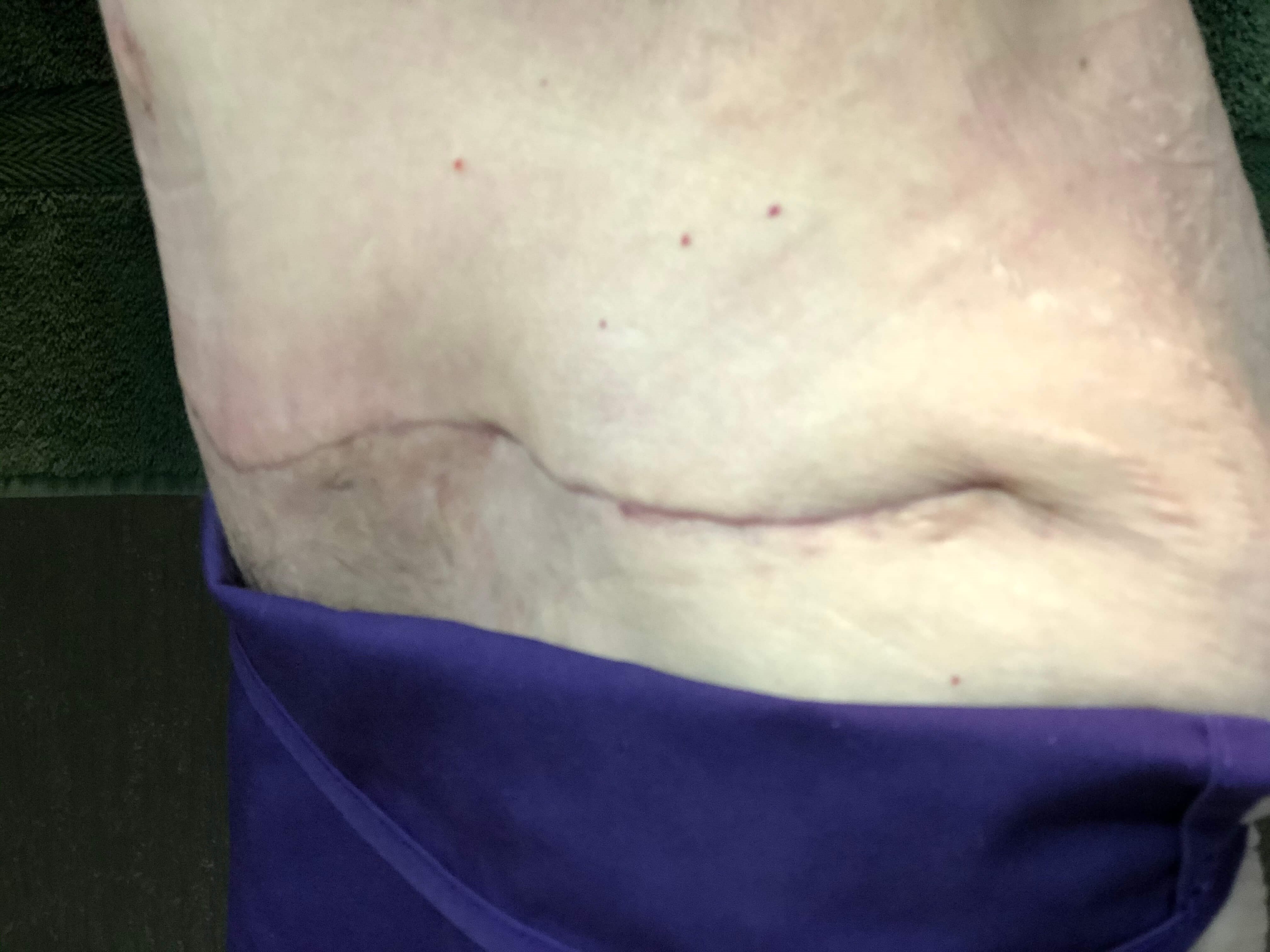 Westlake Woman Has Tummy Tuck After