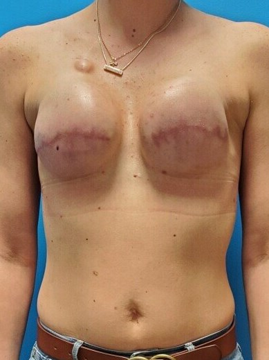 Woman has Breast Cancer After