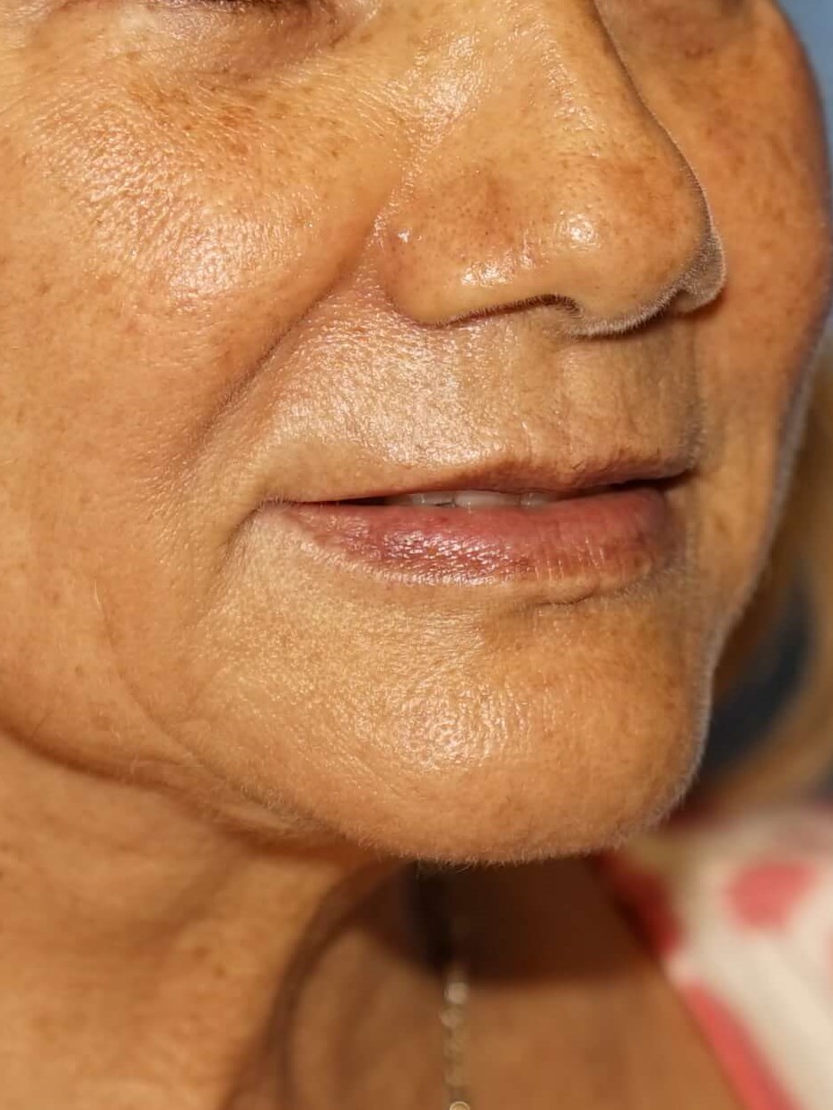 Westlake Woman Has Filler Before