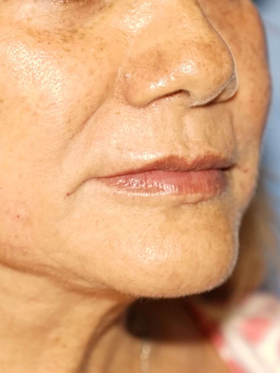 Westlake Woman Has Filler After
