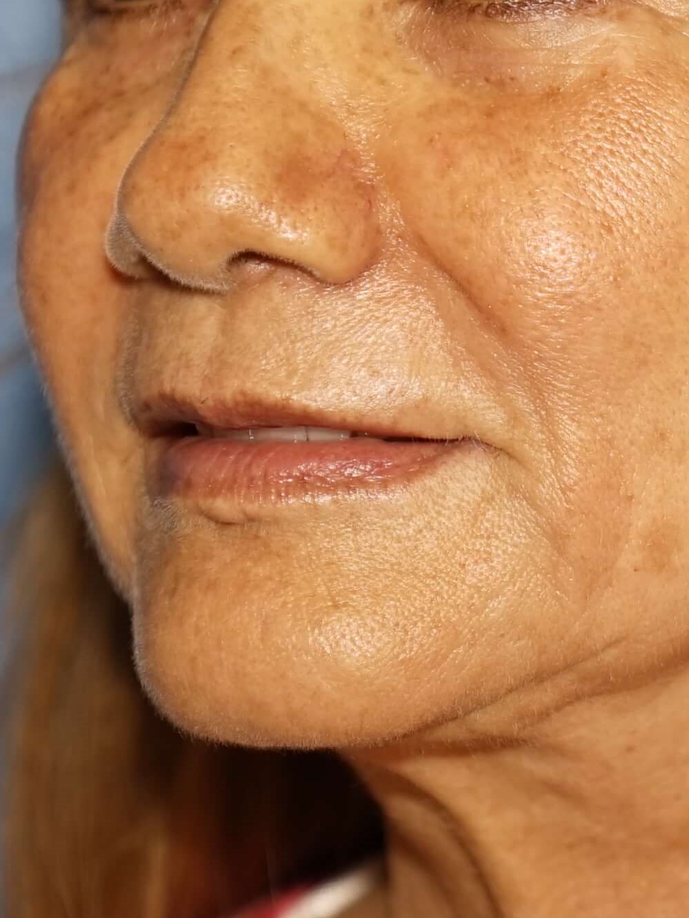 Westlake Woman Has Filler Before