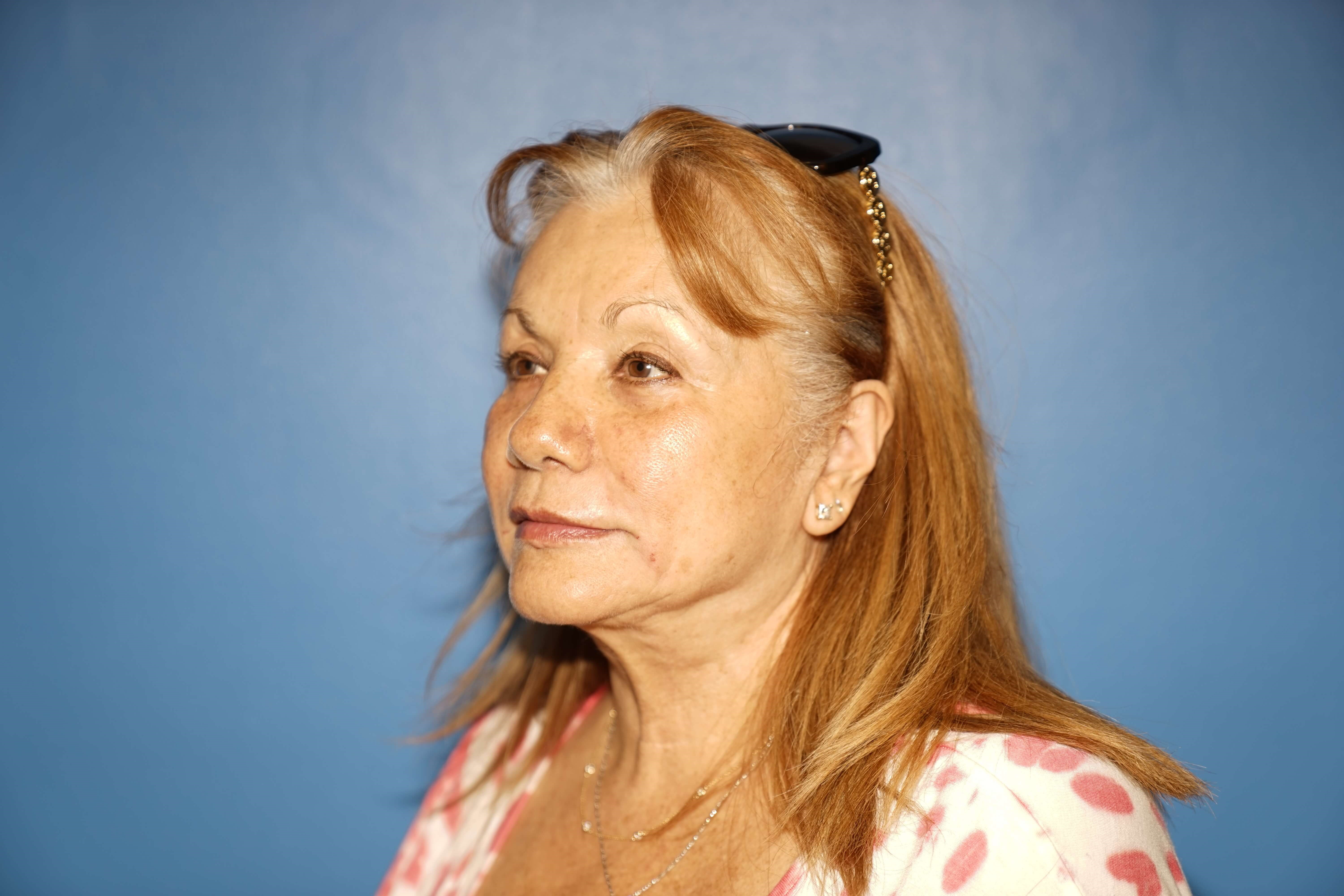 Westlake Woman Has Filler After