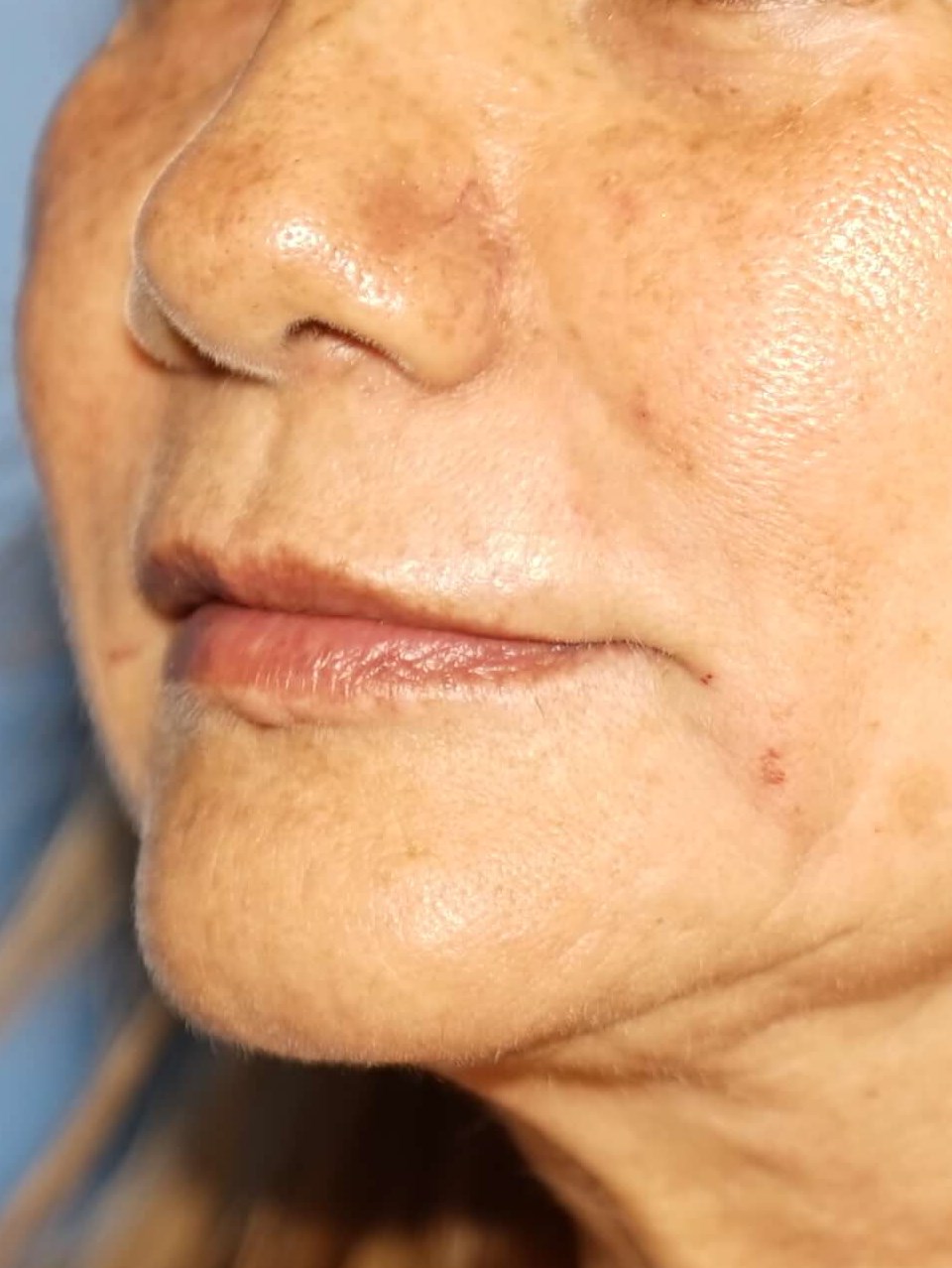 Westlake Woman Has Filler After