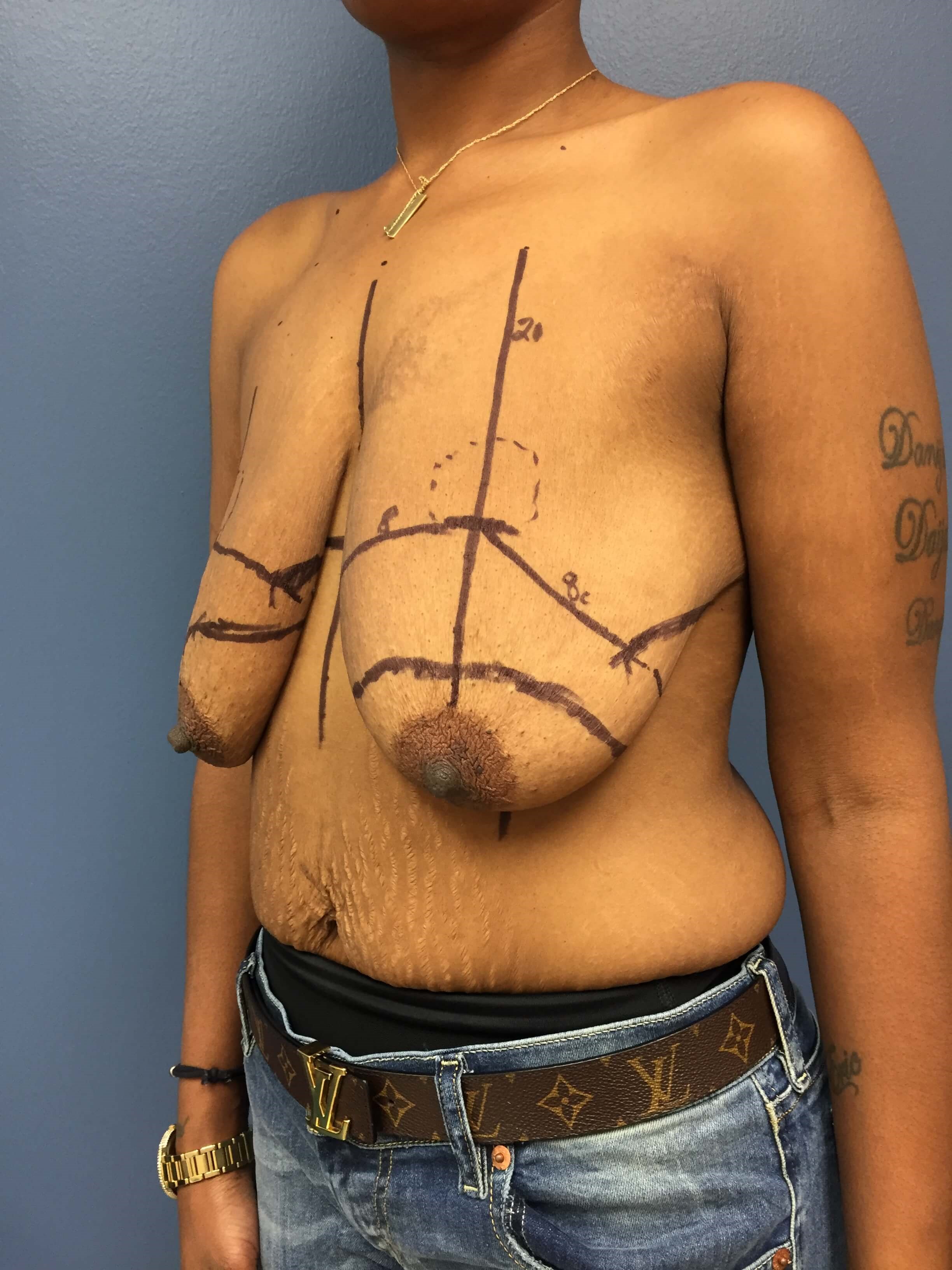 Westlake Woman Has Mastopexy Before