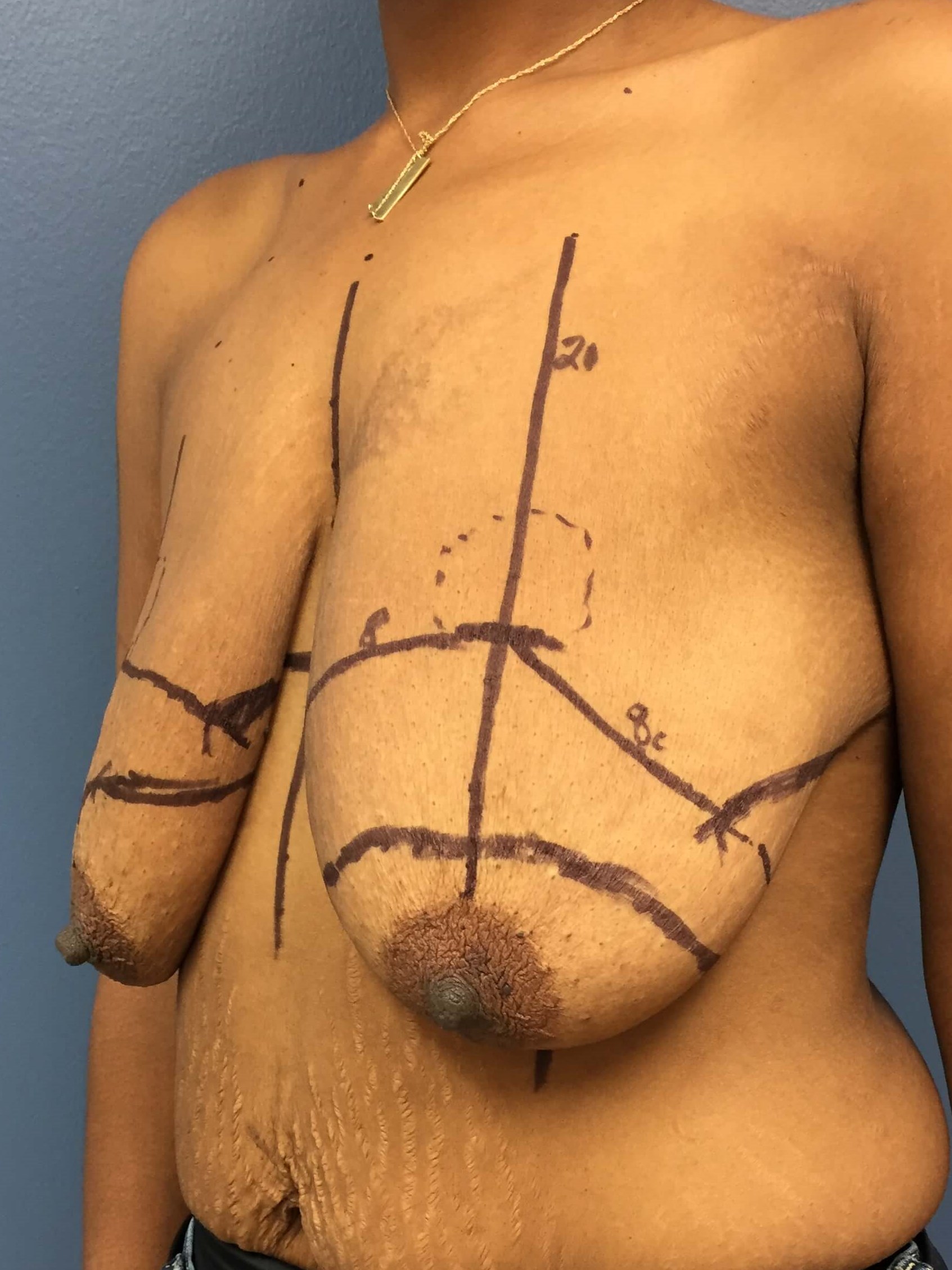 Westlake Woman Has Mastopexy Before